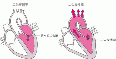 了解瓣膜狭窄和反流