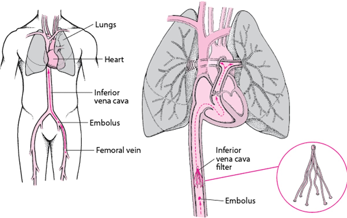 Inferior Vena Cava Filters: One Way to Prevent Pulmonary Embolism