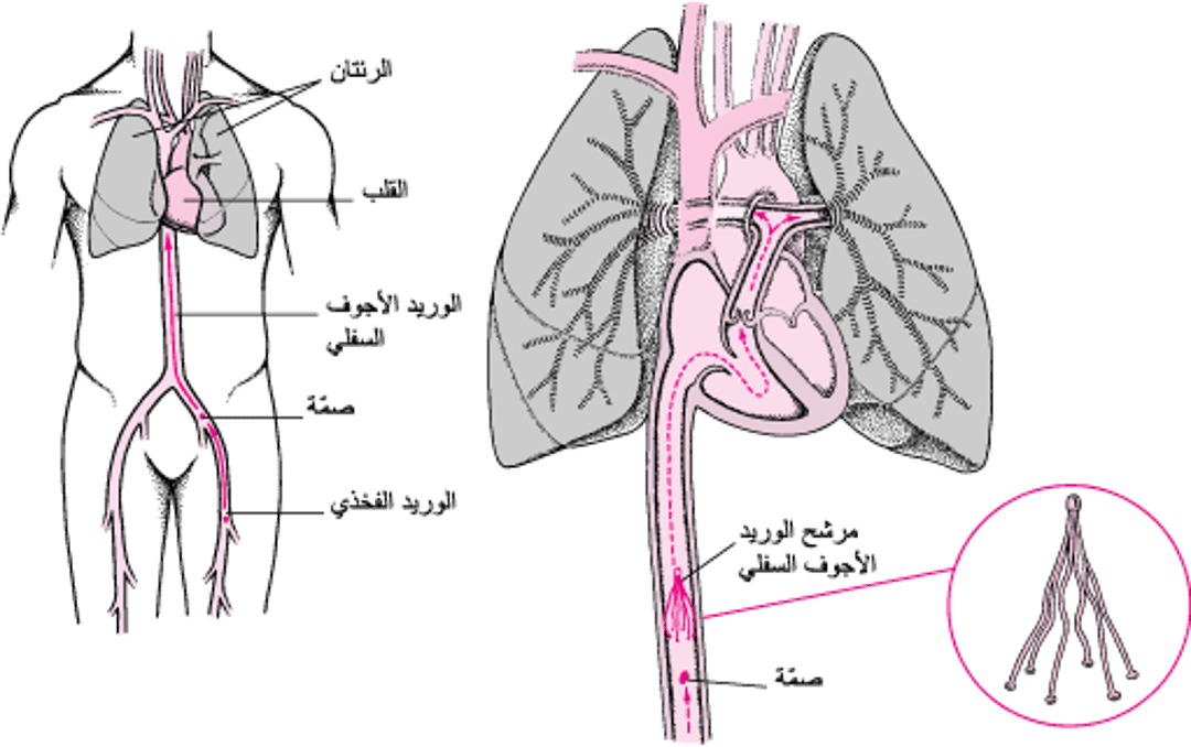 مُرشِّحاتُ الوريد الأجوف السفليّ: طريقة للوِقاية من الانصِمام الرِّئويّ