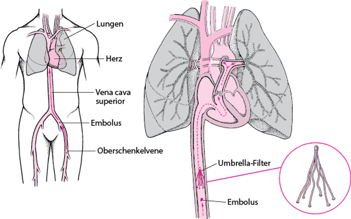 Vena-cava-Filter: Eine Art der Vorbeugung von Lungenembolie