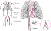 Filtros de vena cava inferior: una manera de prevenir la embolia pulmonar