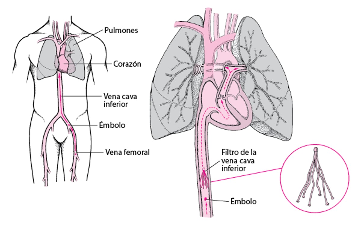 Filtros de vena cava inferior: una manera de prevenir la embolia pulmonar