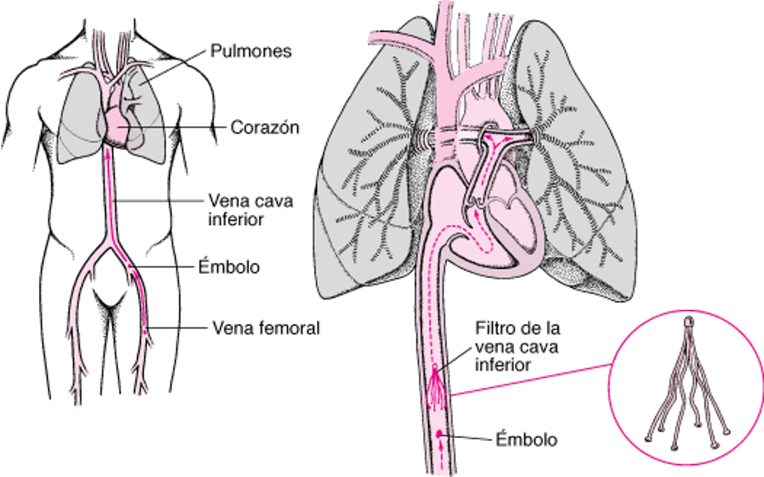Filtros de vena cava inferior: una manera de prevenir la embolia pulmonar
