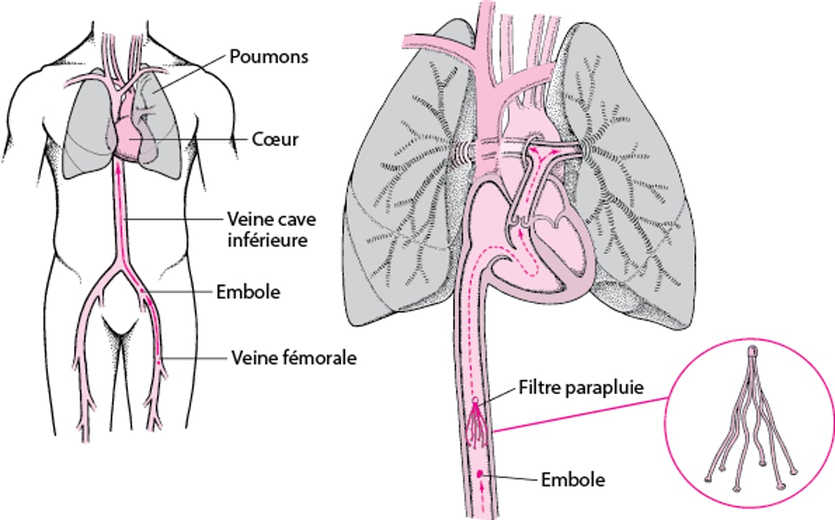 Filtres de la veine cave inférieure : une façon d’éviter une embolie pulmonaire