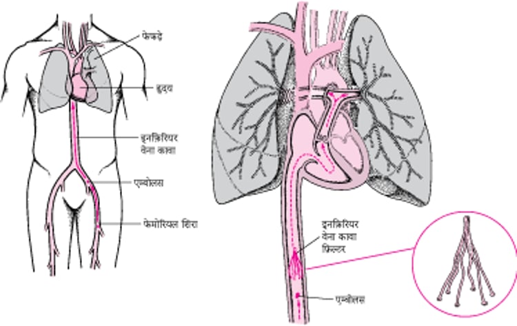 इन्फीरियर वेना केवा फिल्टर: पल्मोनरी एम्बॉलिज्म को रोकने का एक तरीका