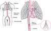 Filtri nella vena cava inferiore: un modo per prevenire l’embolia polmonare