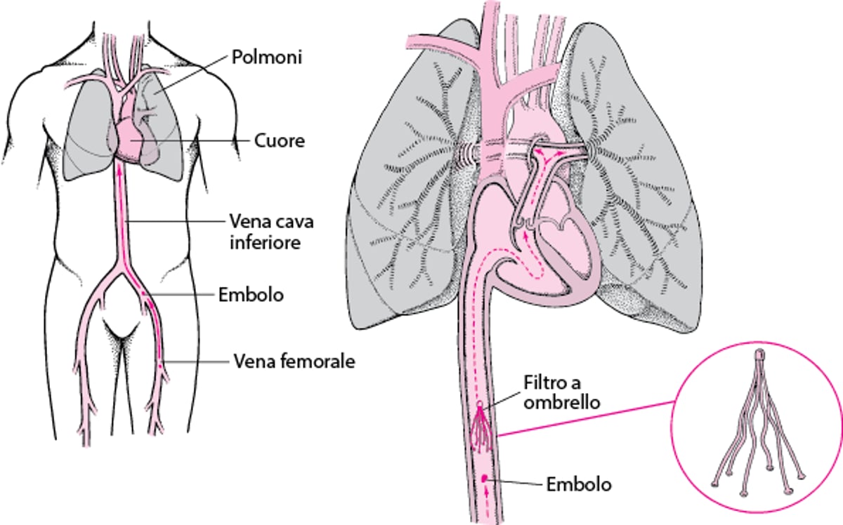 Filtri nella vena cava inferiore: un modo per prevenire l’embolia polmonare