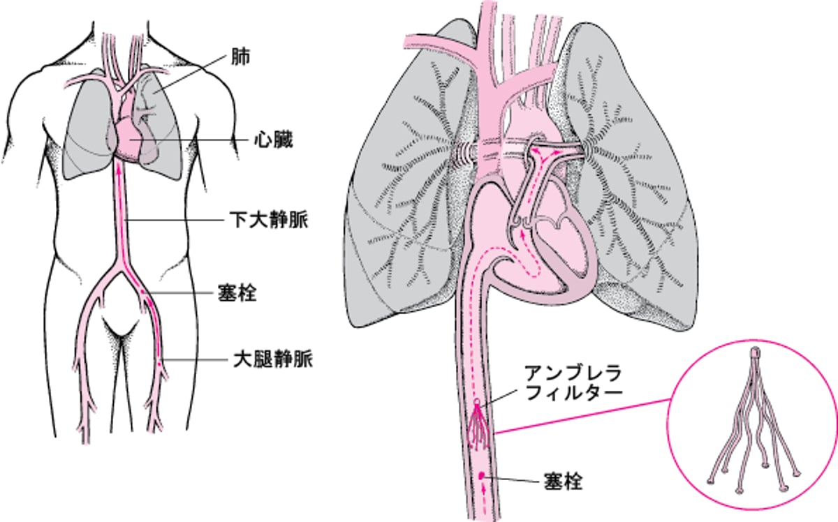 下大静脈かだいじょうみゃくフィルターによる肺塞栓症はいそくせんしょうの予防よぼう