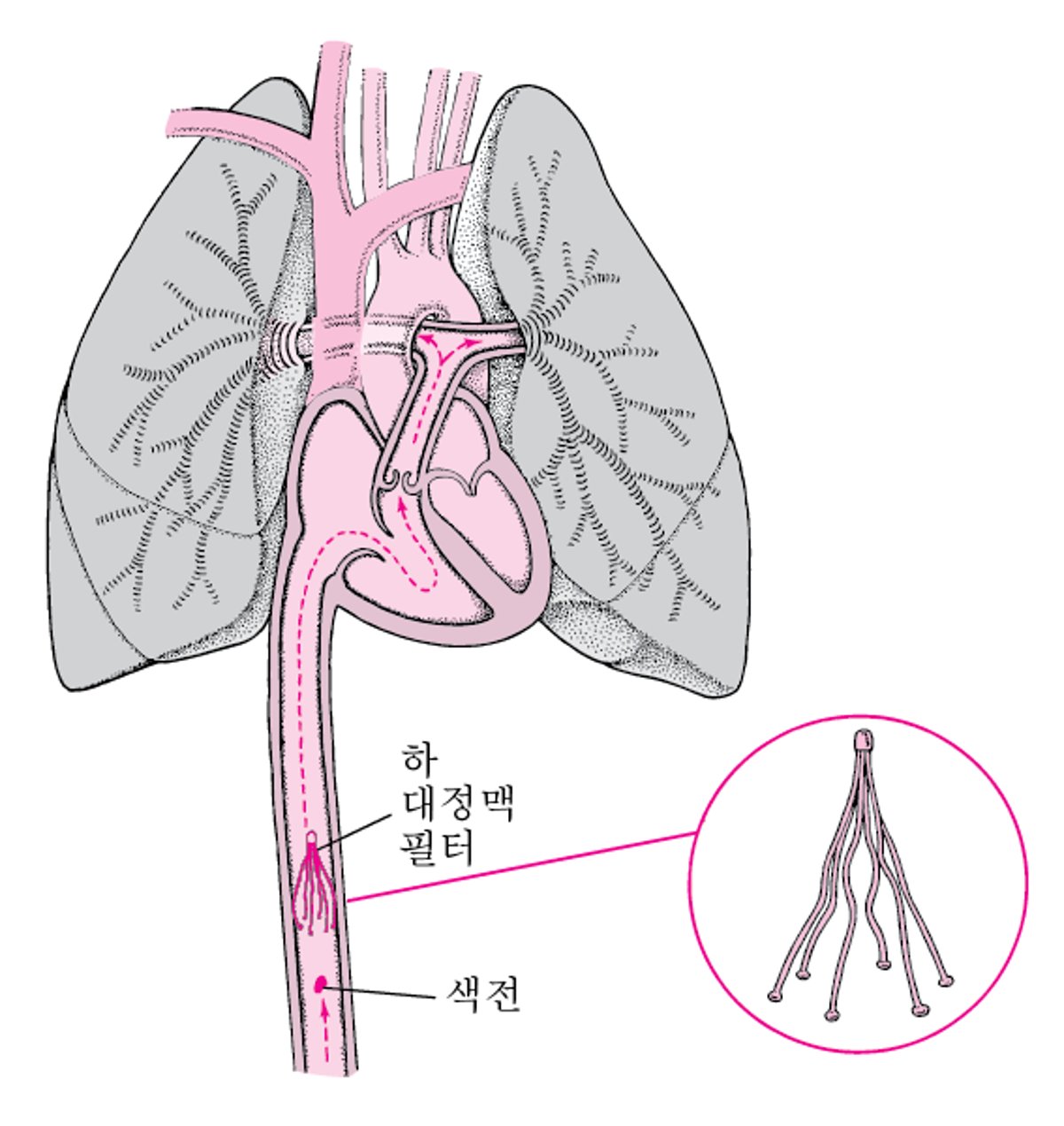 하대 정맥 필터: 폐색전증 방지 방법의 하나