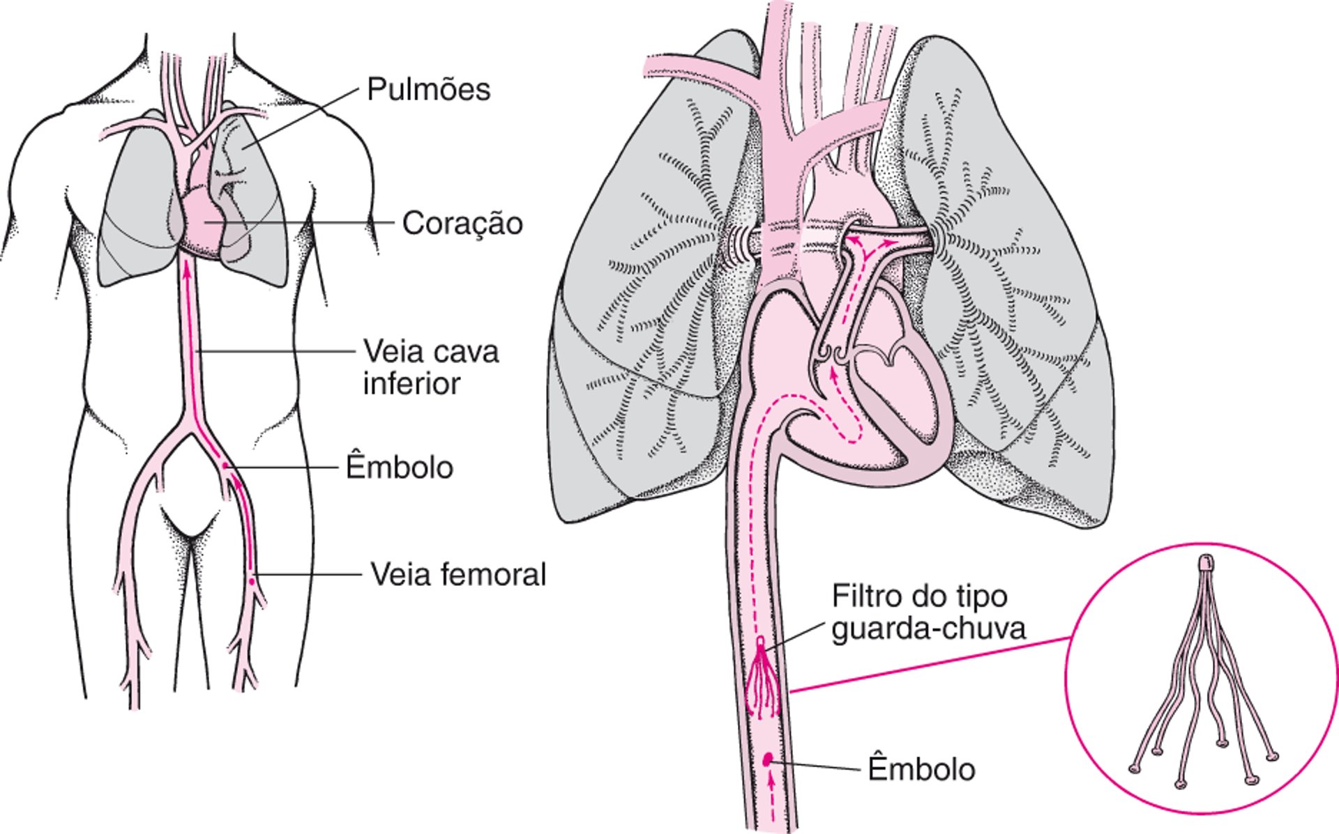 Filtros de veia cava inferior: Uma forma de prevenir a embolia pulmonar