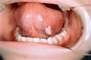 Verruca genitale nella bocca