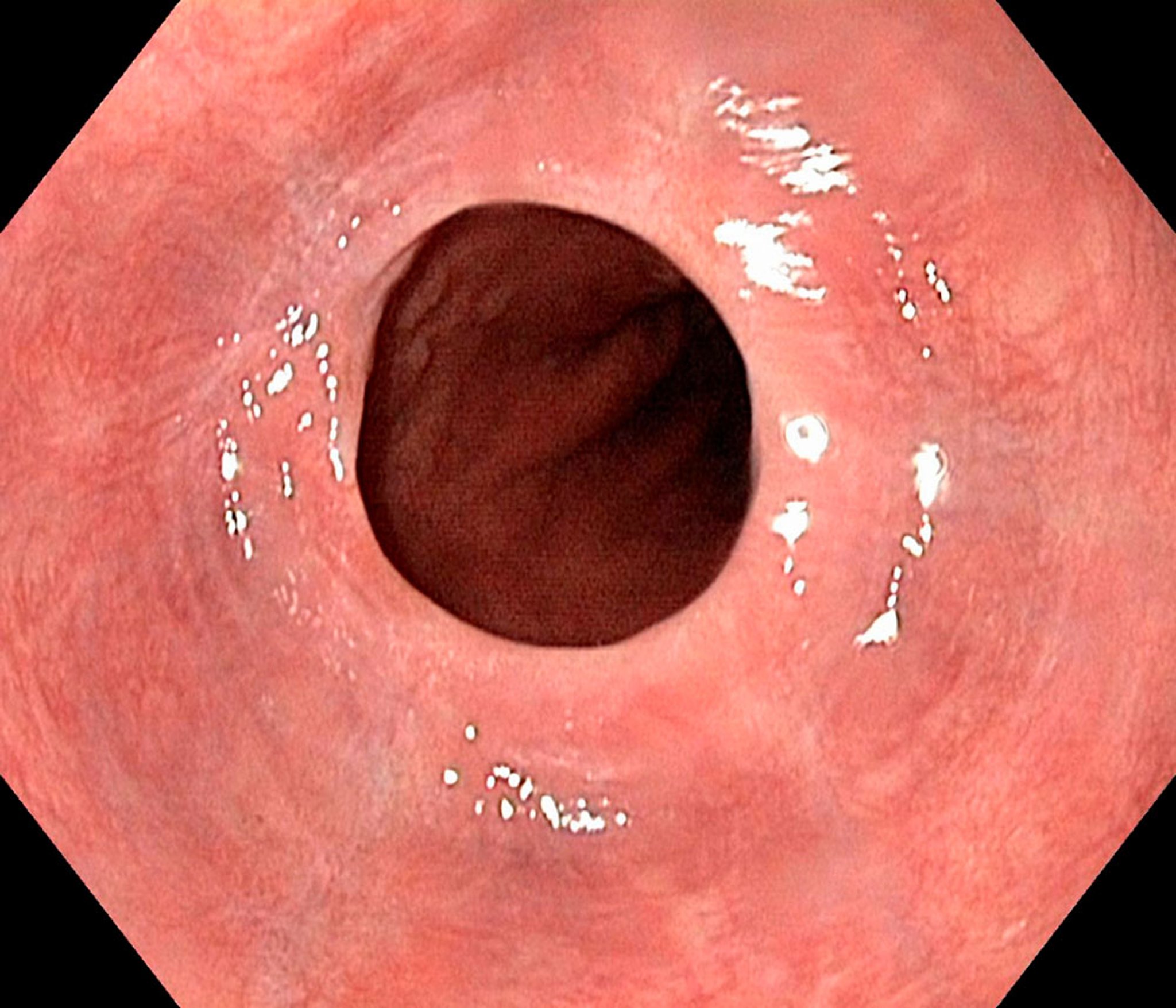 Esophageal Web