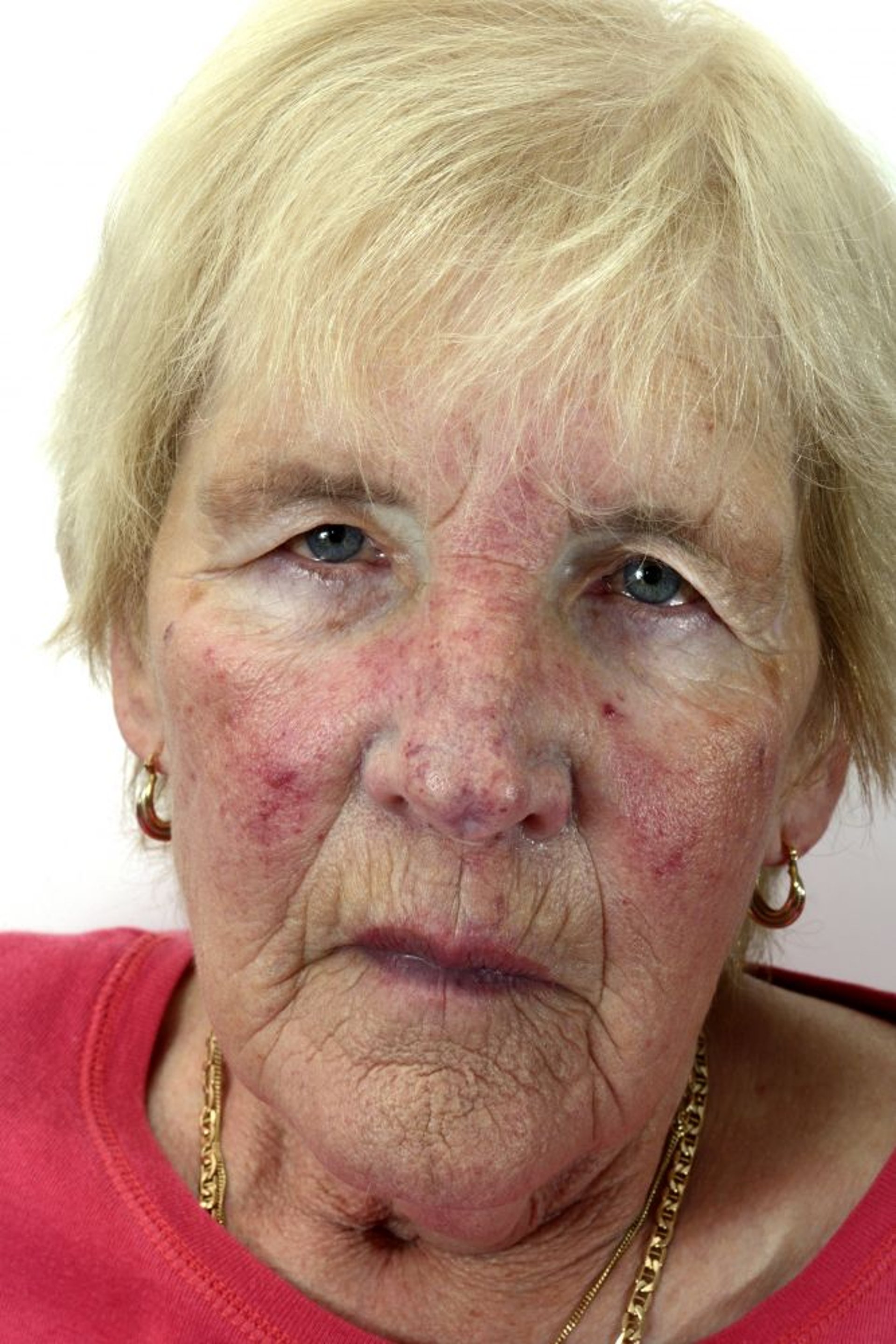 Sindrome carcinoide (eritrosi facciale)