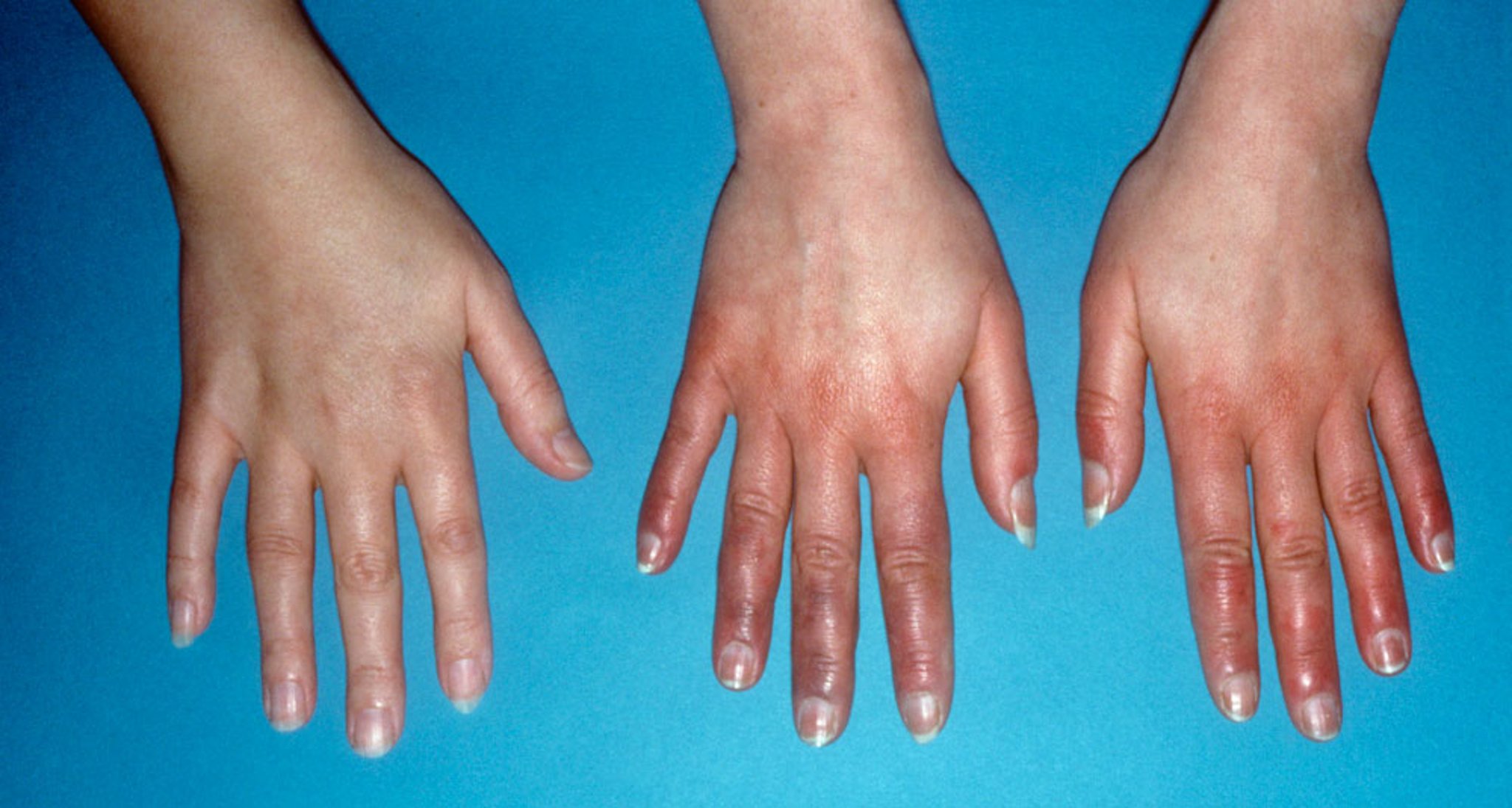 Acrocianosis en las manos (1)