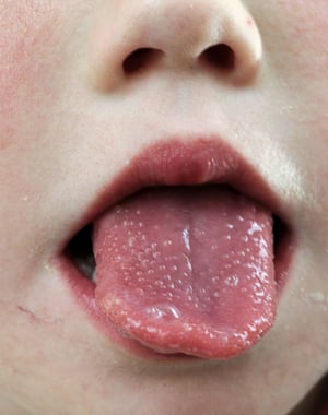 Lingua rosso fragola