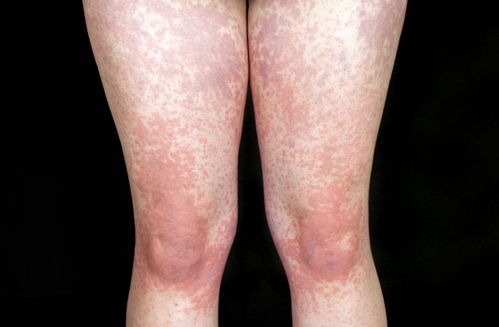 Eruzione cutanea causata dalla mononucleosi infettiva