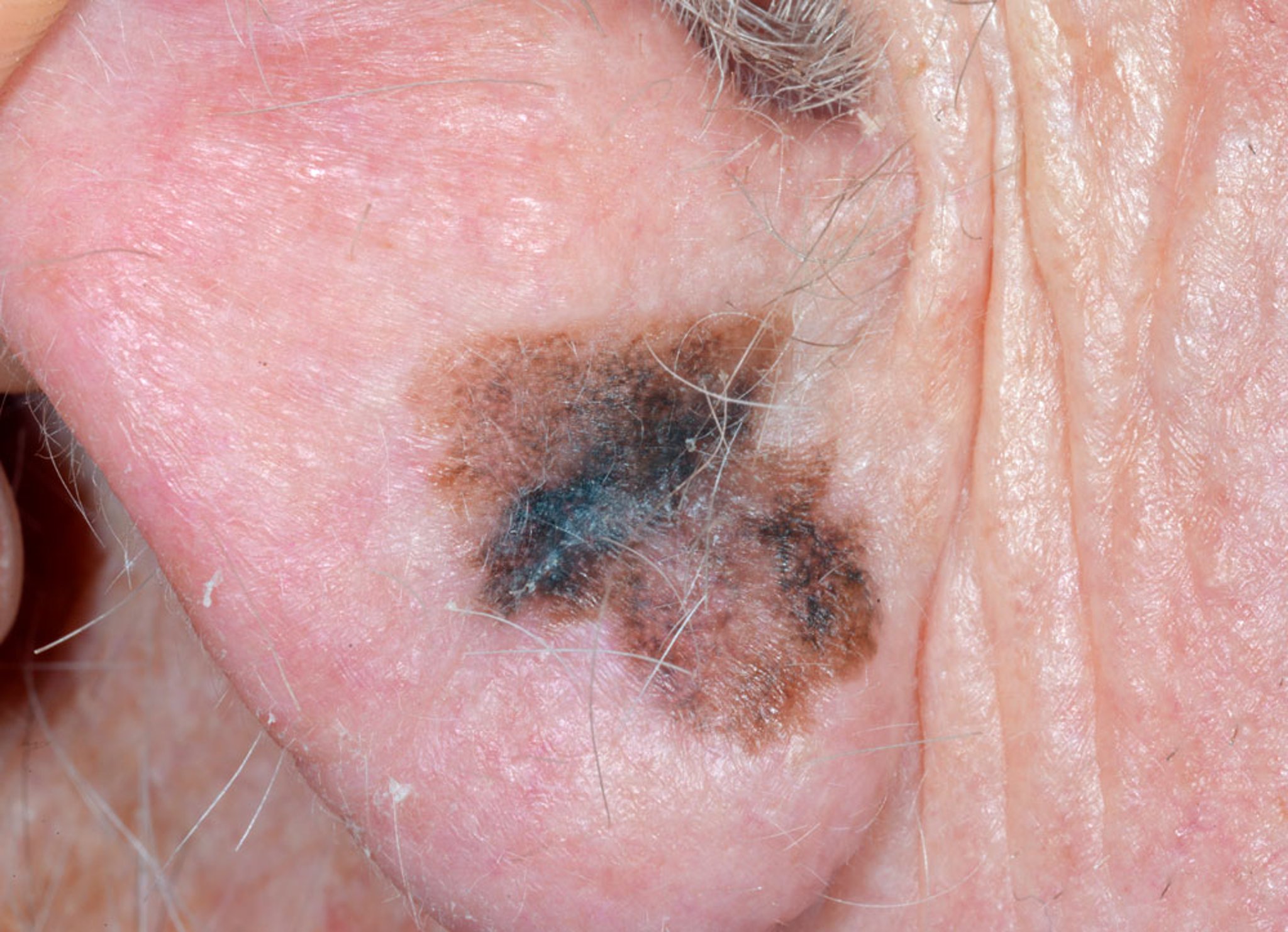 Malignant Melanoma (Earlobe)
