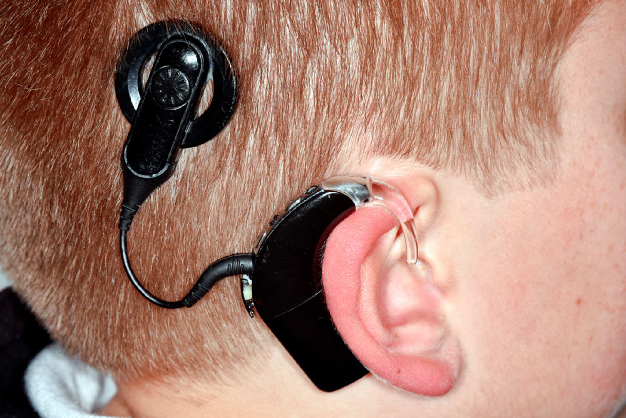 Cochlear Implant in a Child