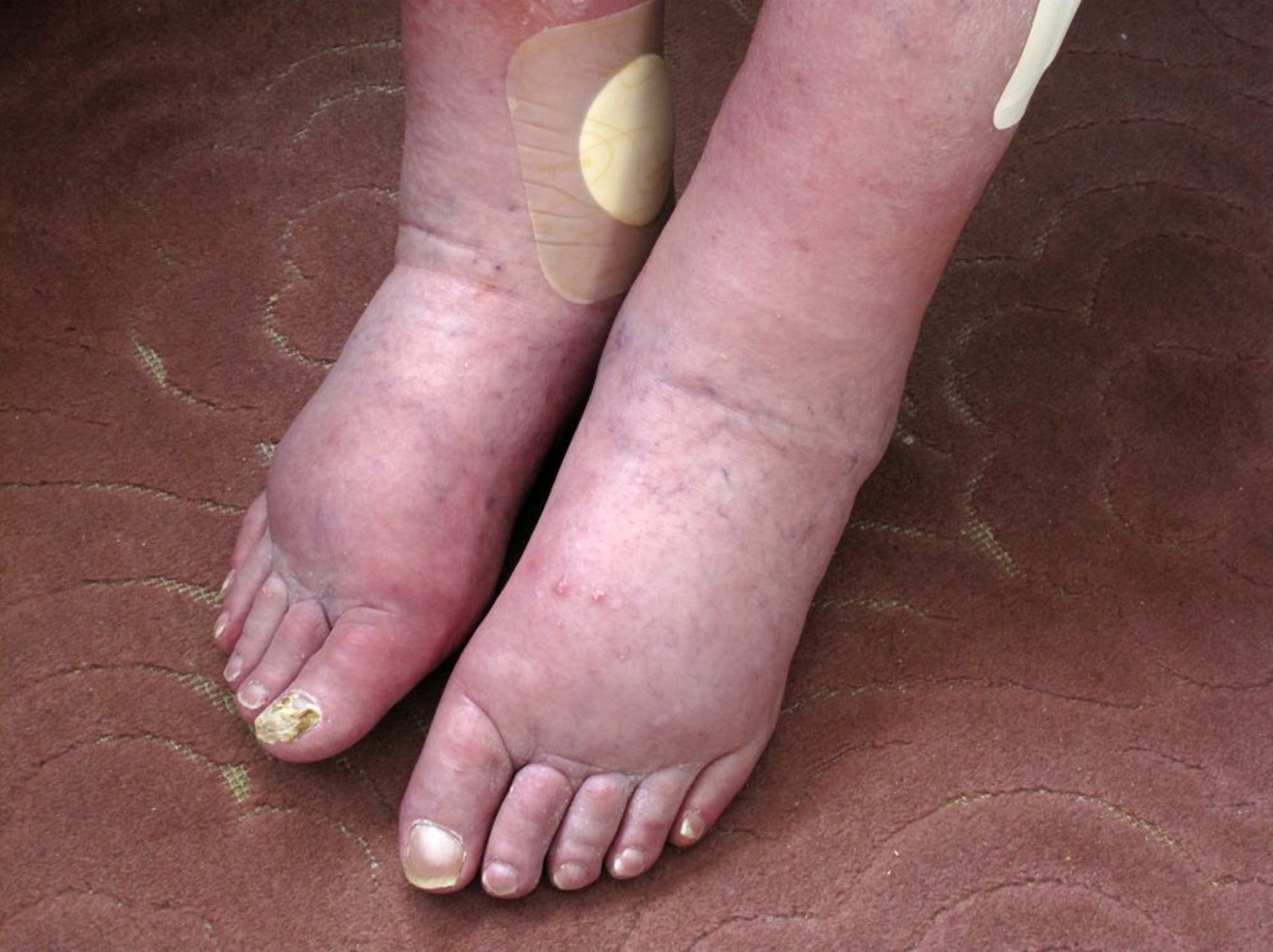 Gonfiore (edema) delle gambe