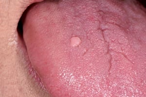 Verruca comune nella bocca