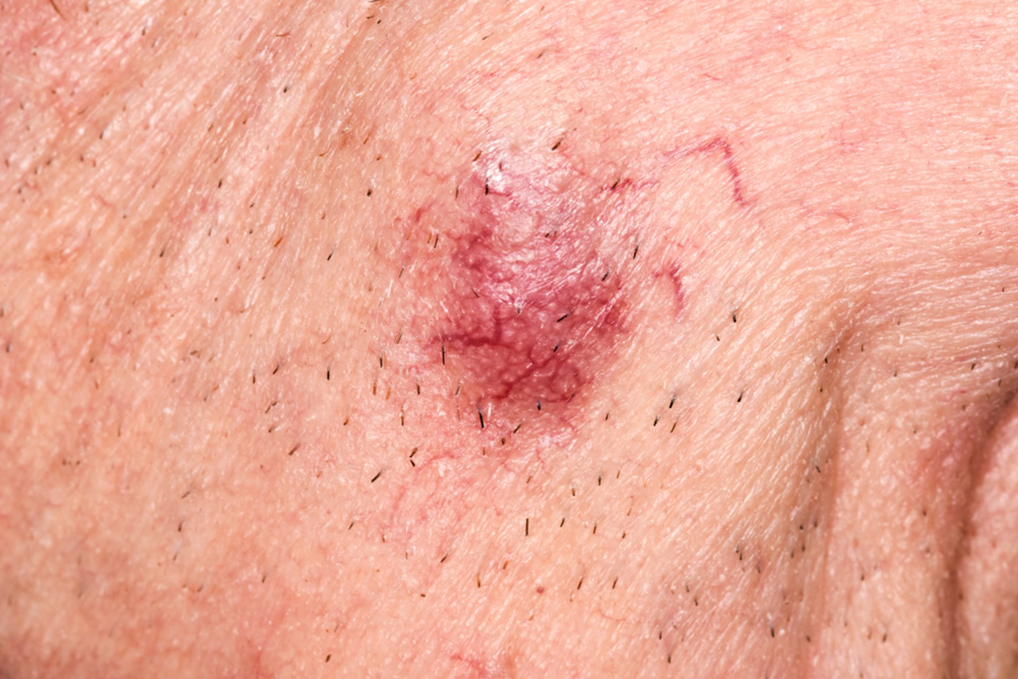 Merkel Cell Carcinoma