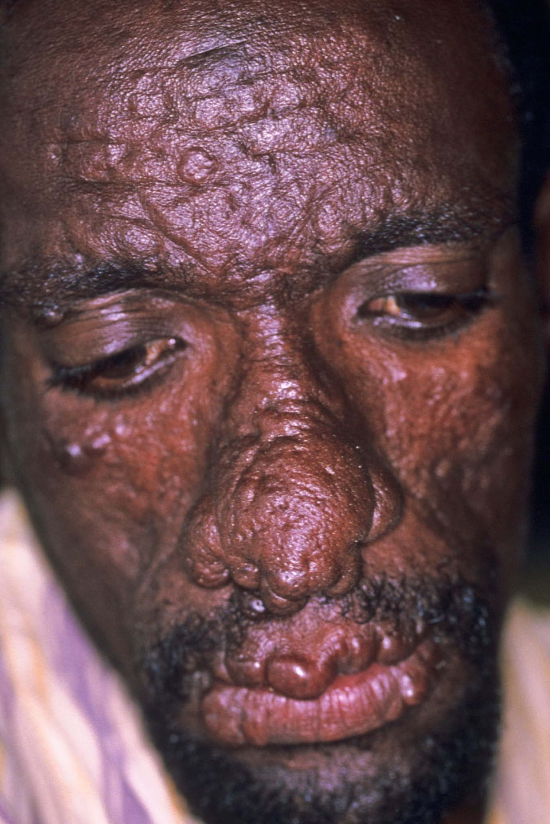 Leishmaniasis cutánea posterior a Kala-Azar