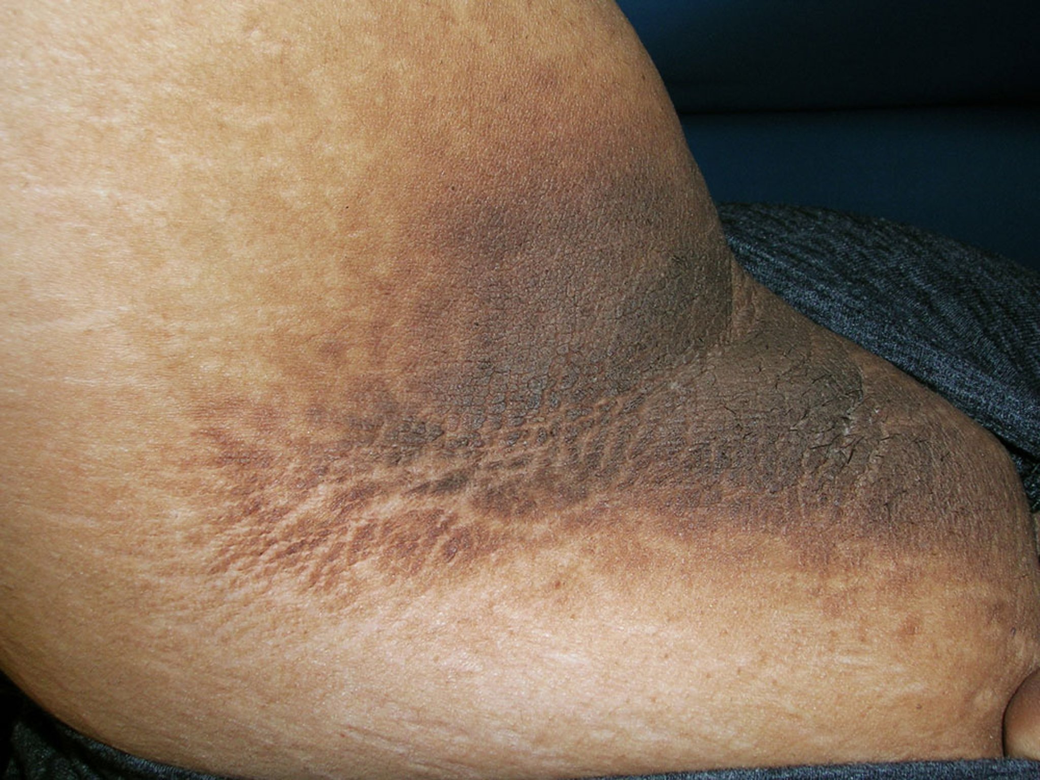 Acanthosis Nigricans (Elbow Fold)