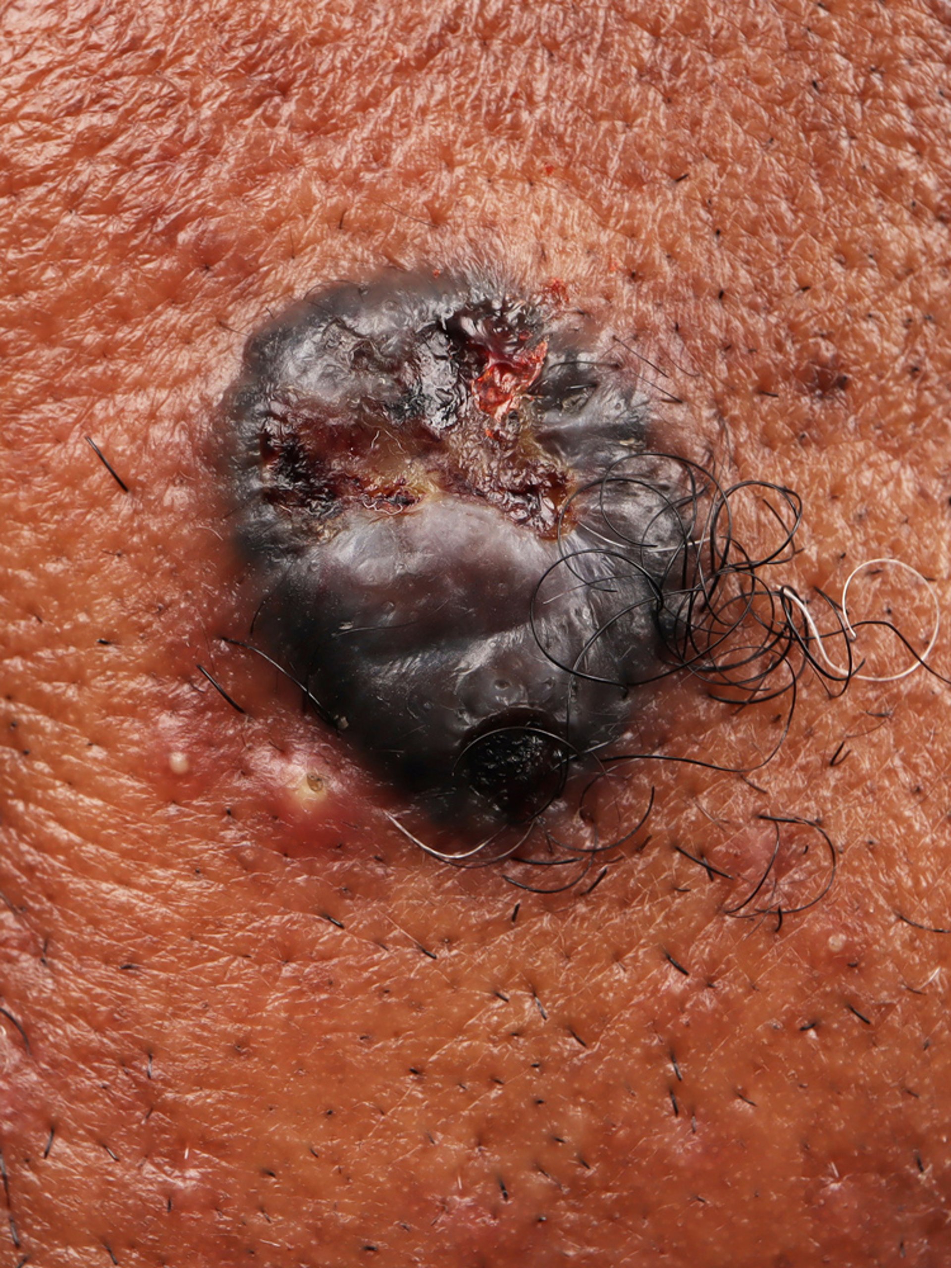 Pigmented Basal Cell Carcinoma