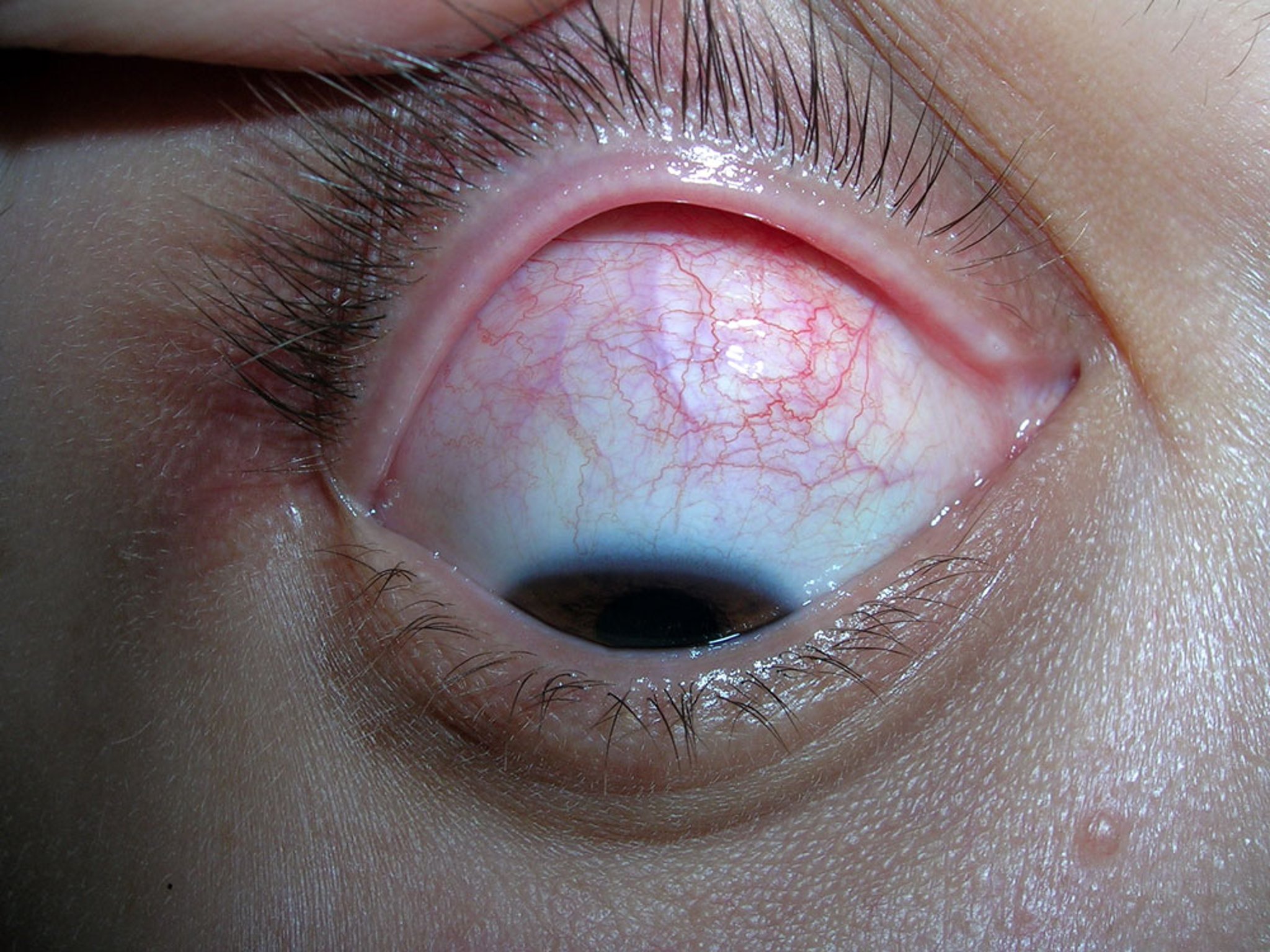 Scleritis