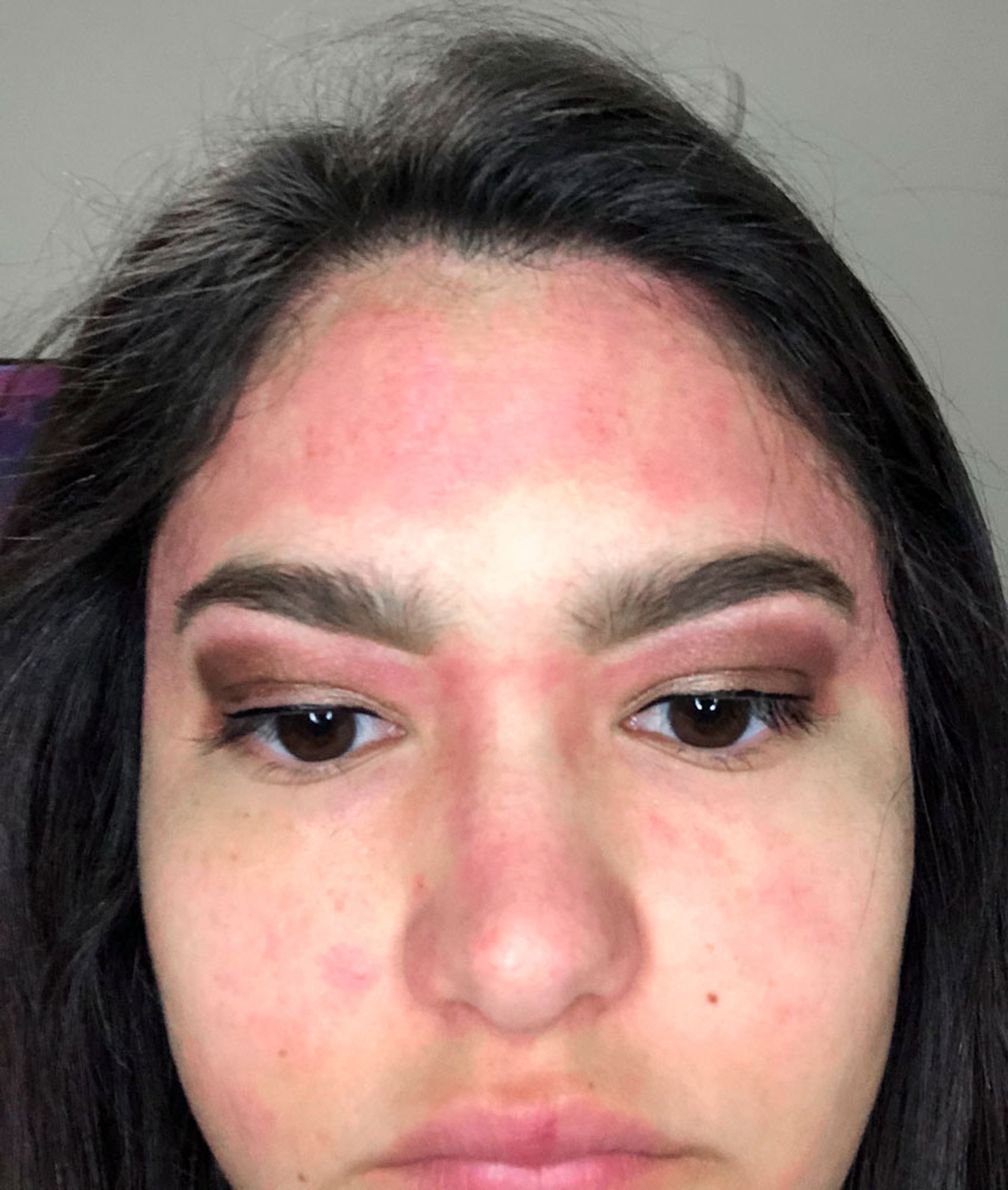 Heliotroper Ausschlag