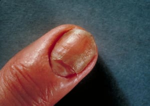 Infezione delle unghie (candidosi)