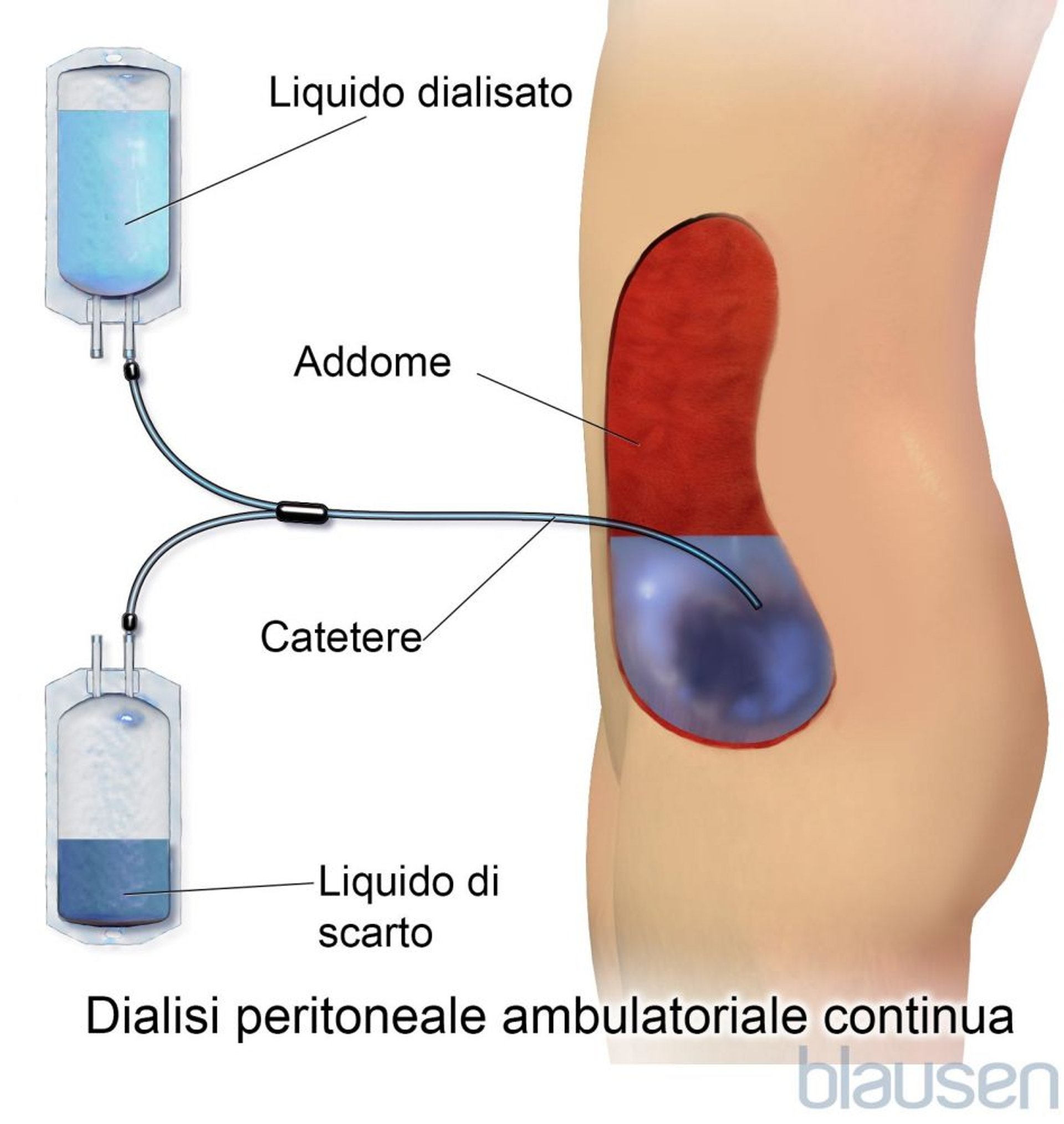 Dialisi peritoneale ambulatoriale continua