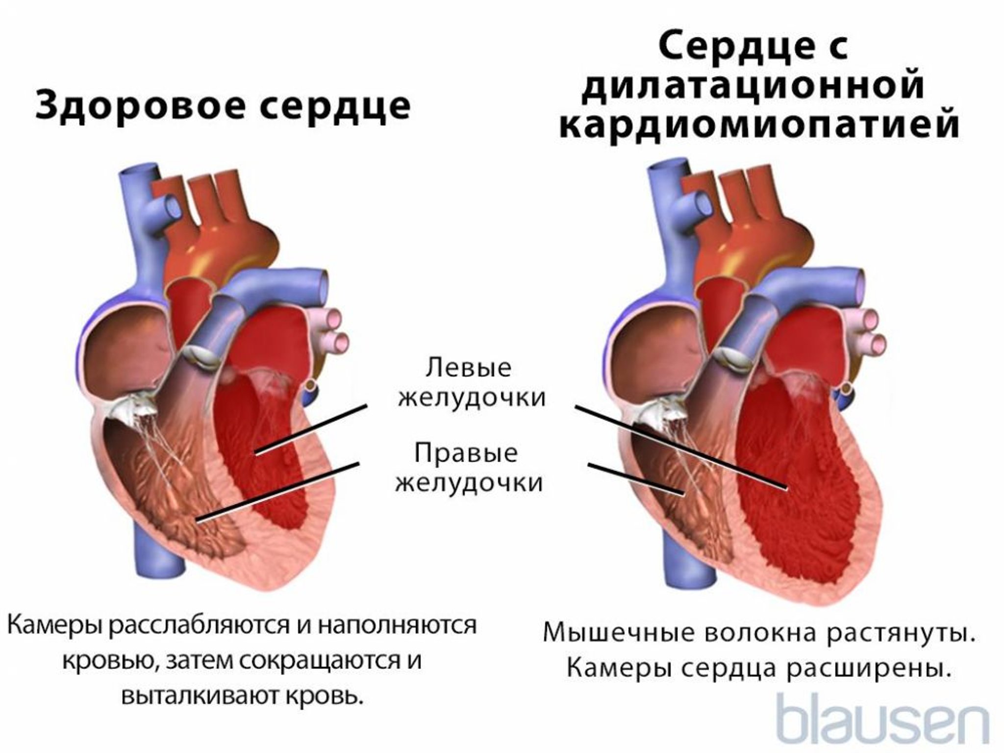 Дилатационная кардиомиопатия