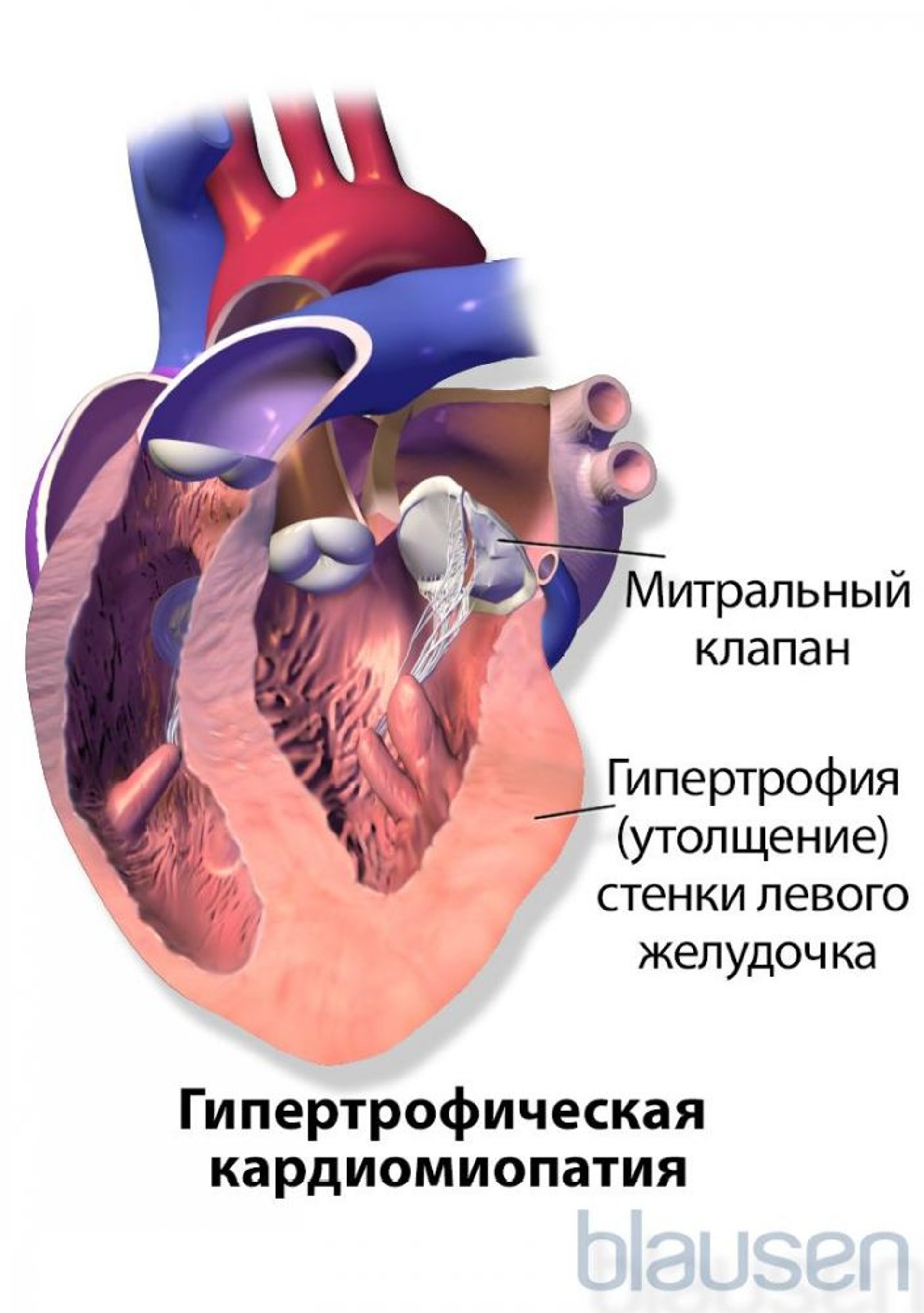 Гипертрофическая кардиомиопатия