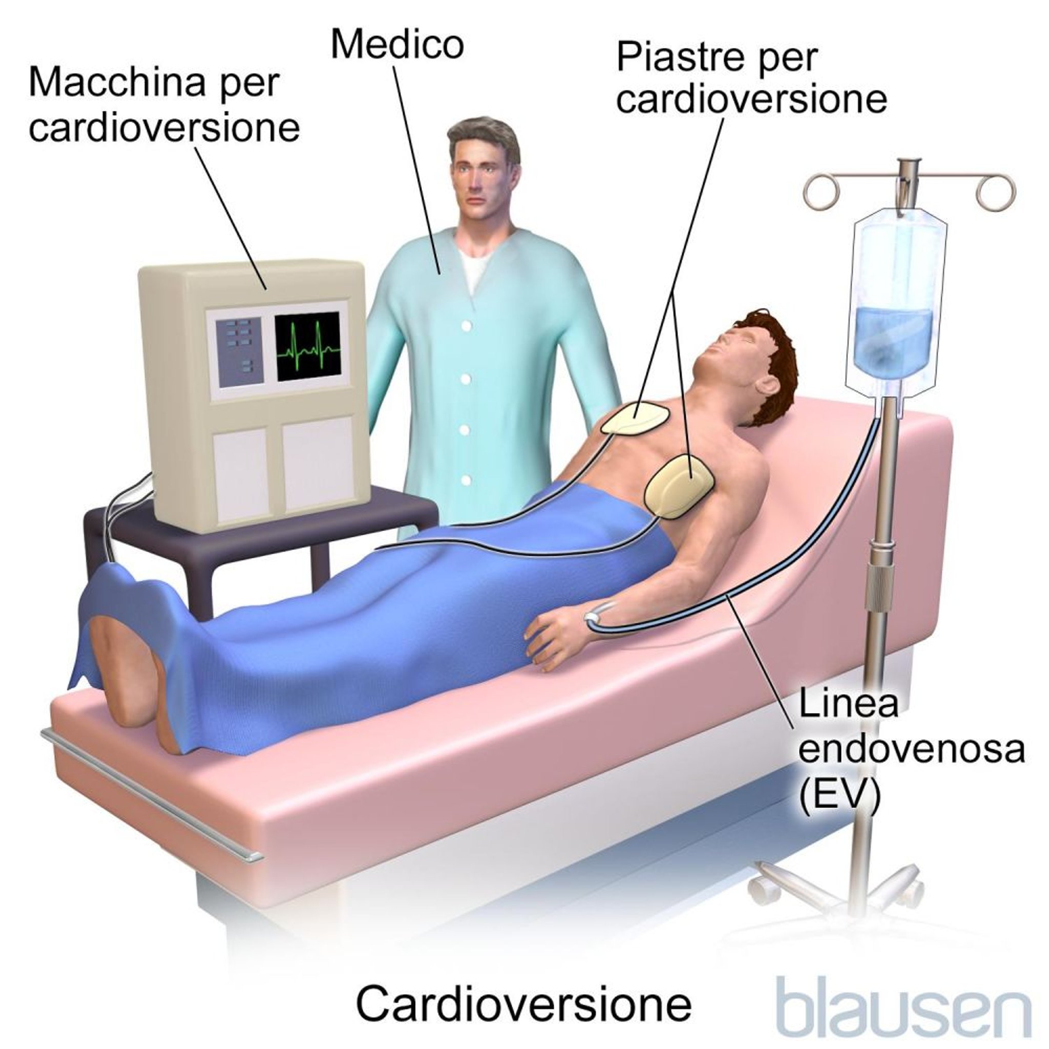 Cardioversione