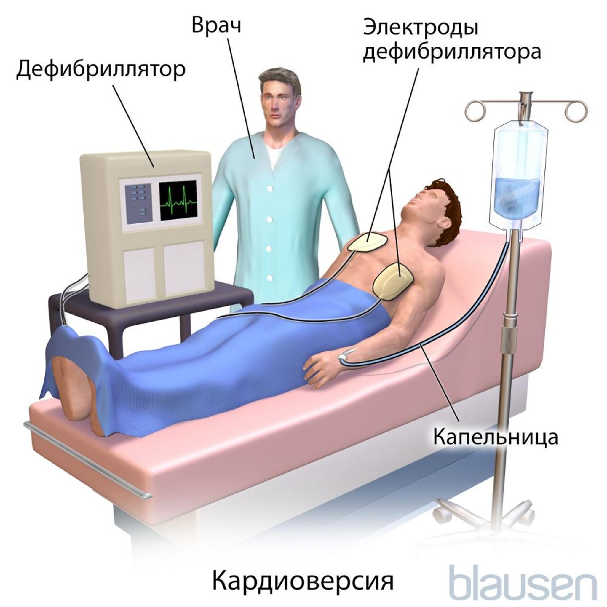 Кардиоверсии