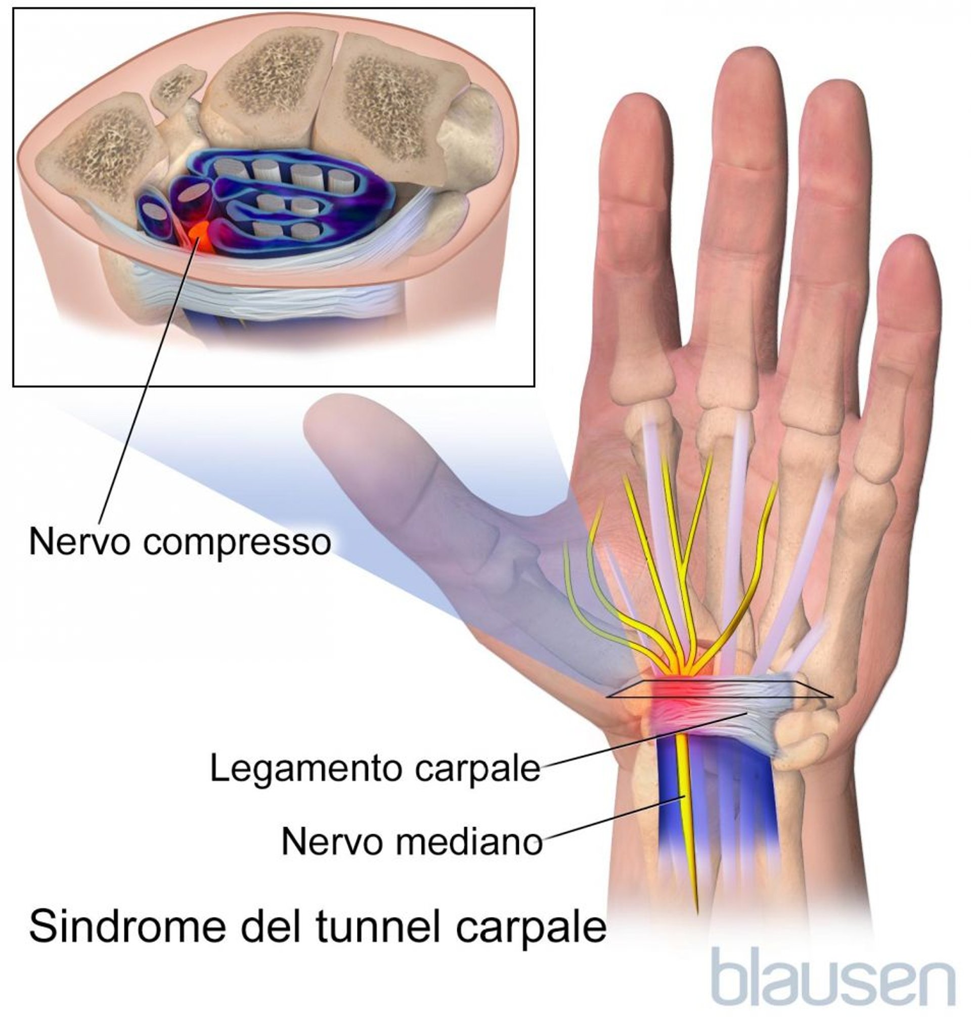 Sindrome del tunnel carpale