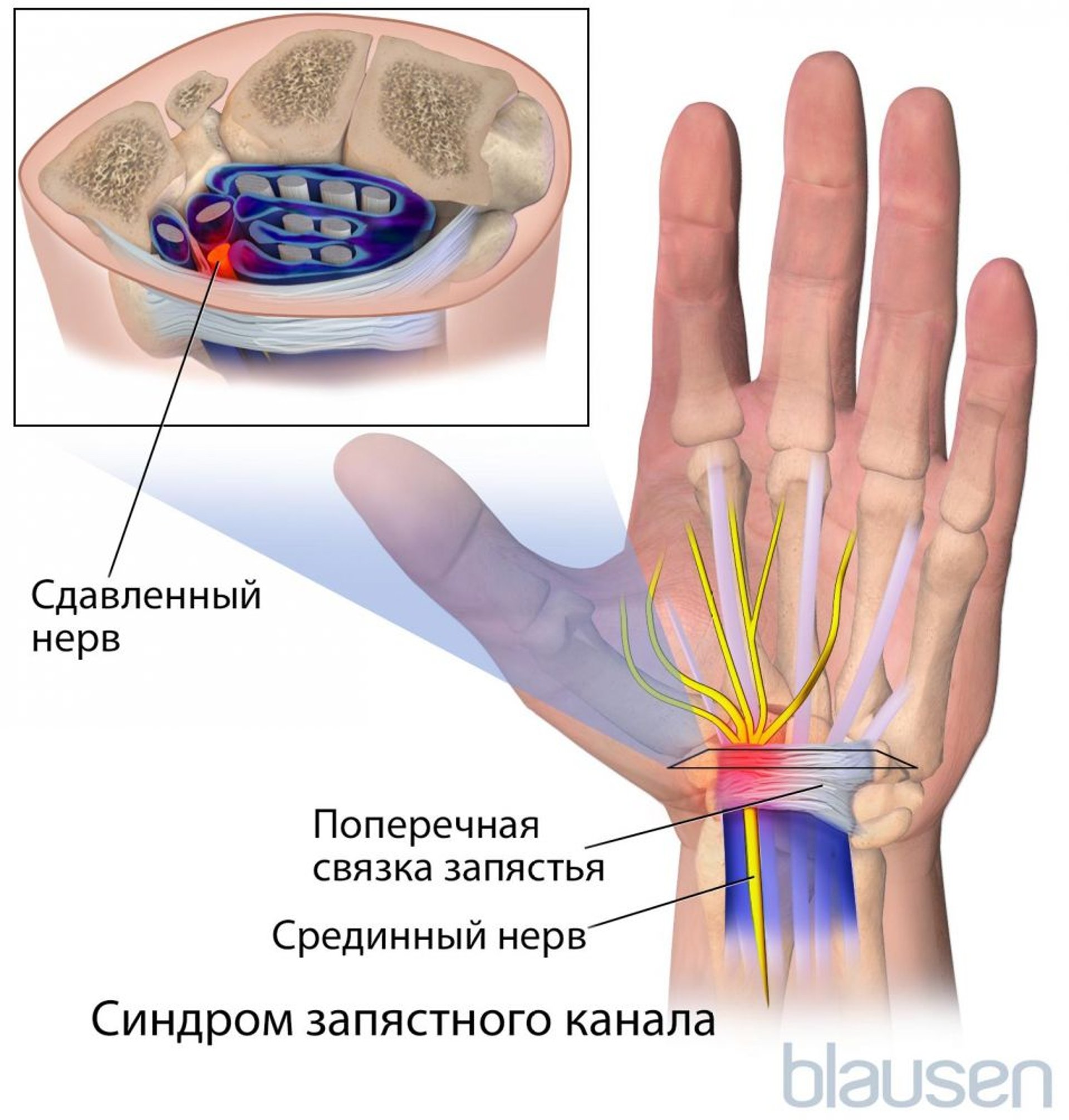 Синдром запястного канала