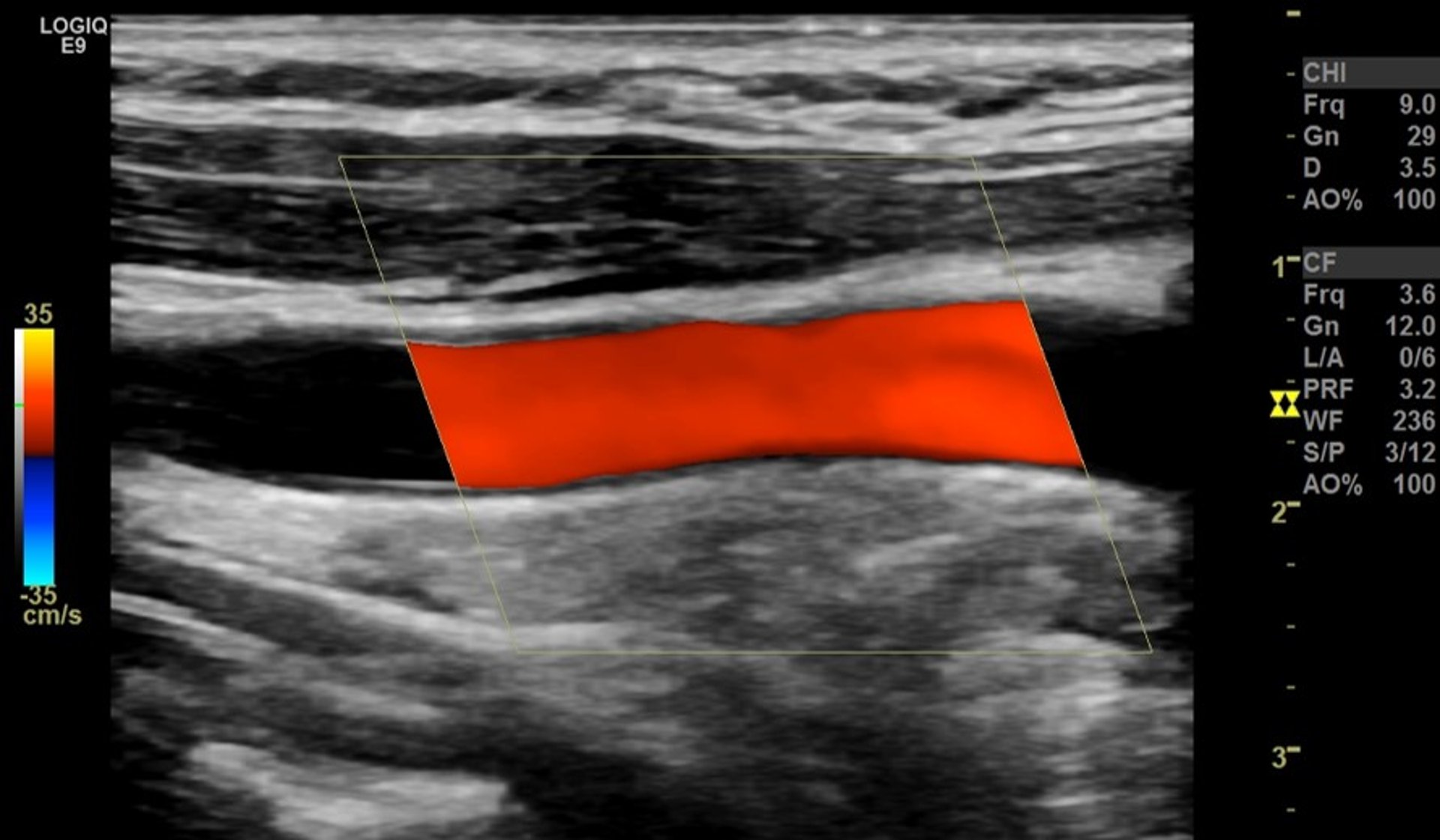 Color Doppler Ultrasonography of Carotid Artery