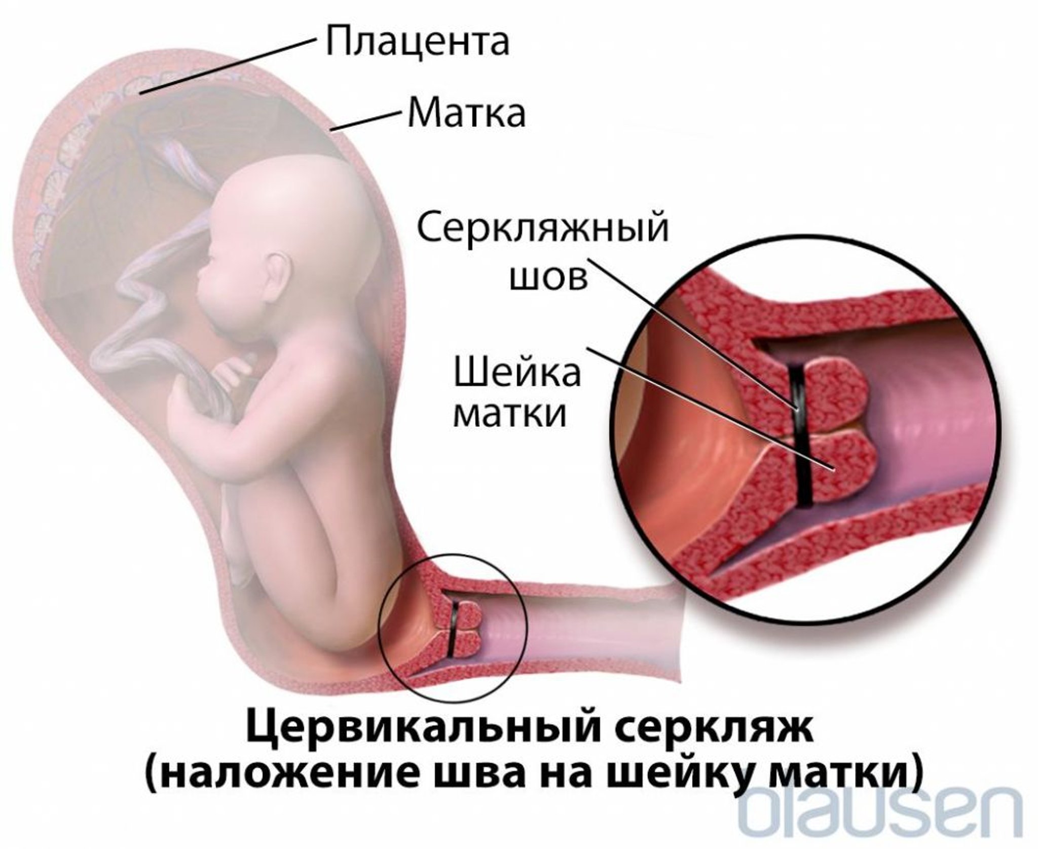 Шов на шейку матки