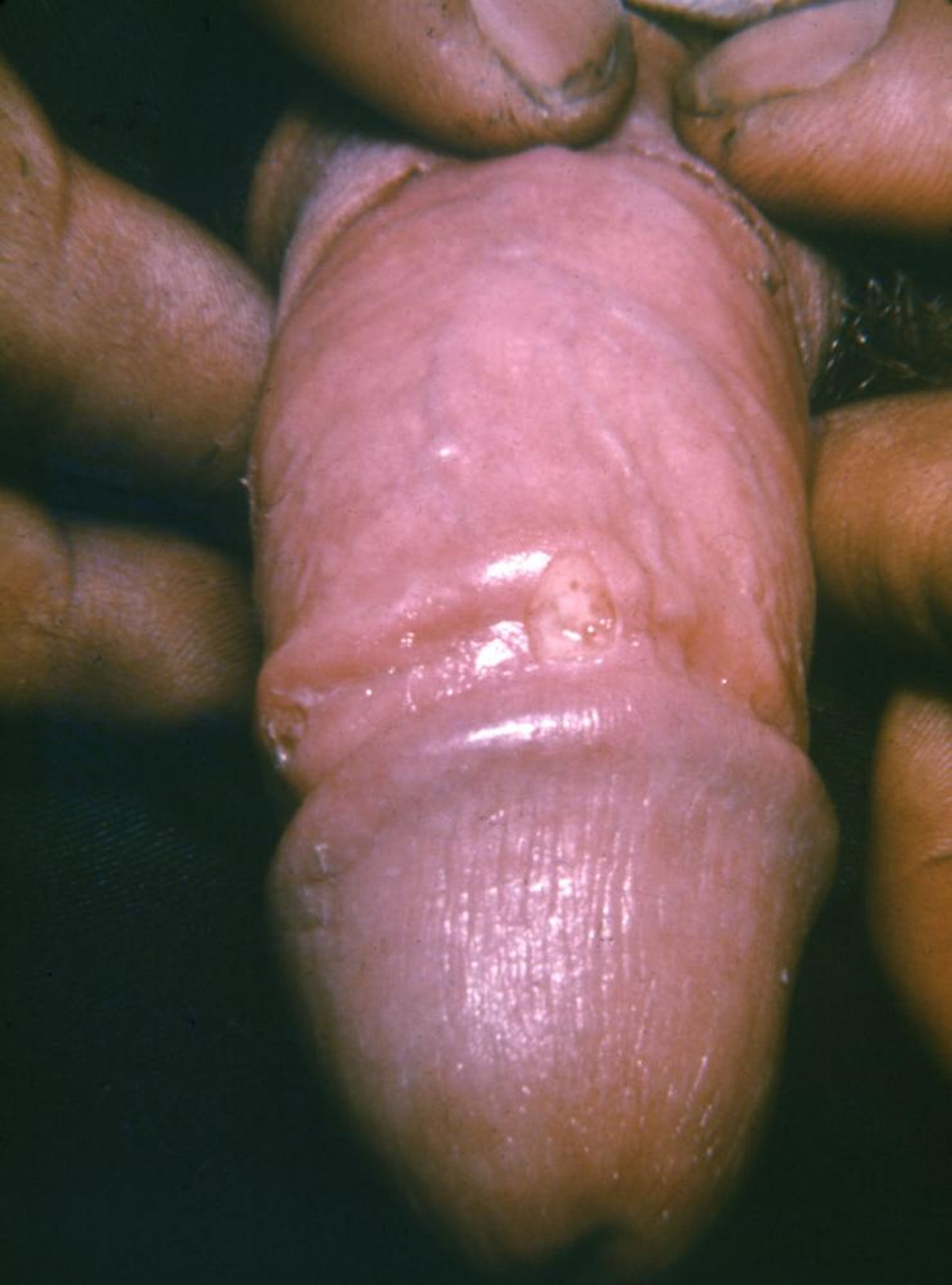Ulcera genitale