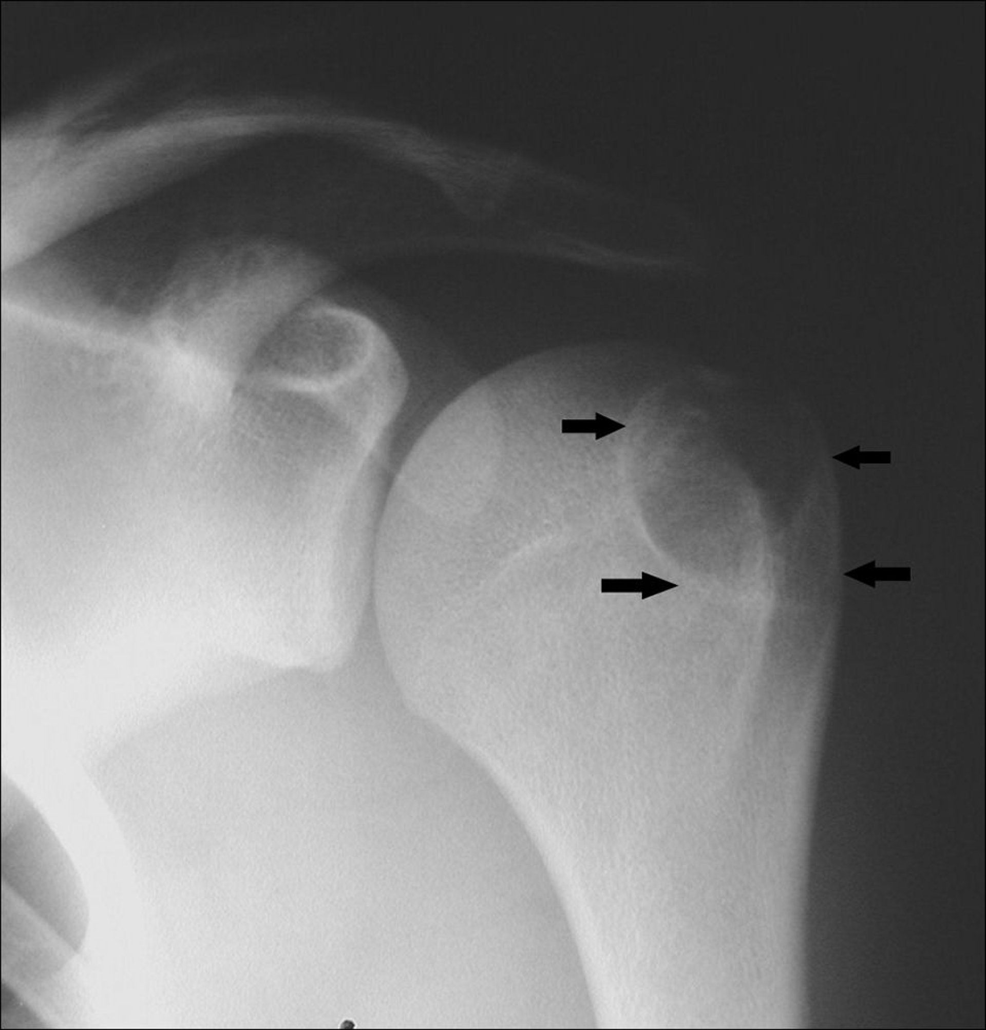 Condroblastoma