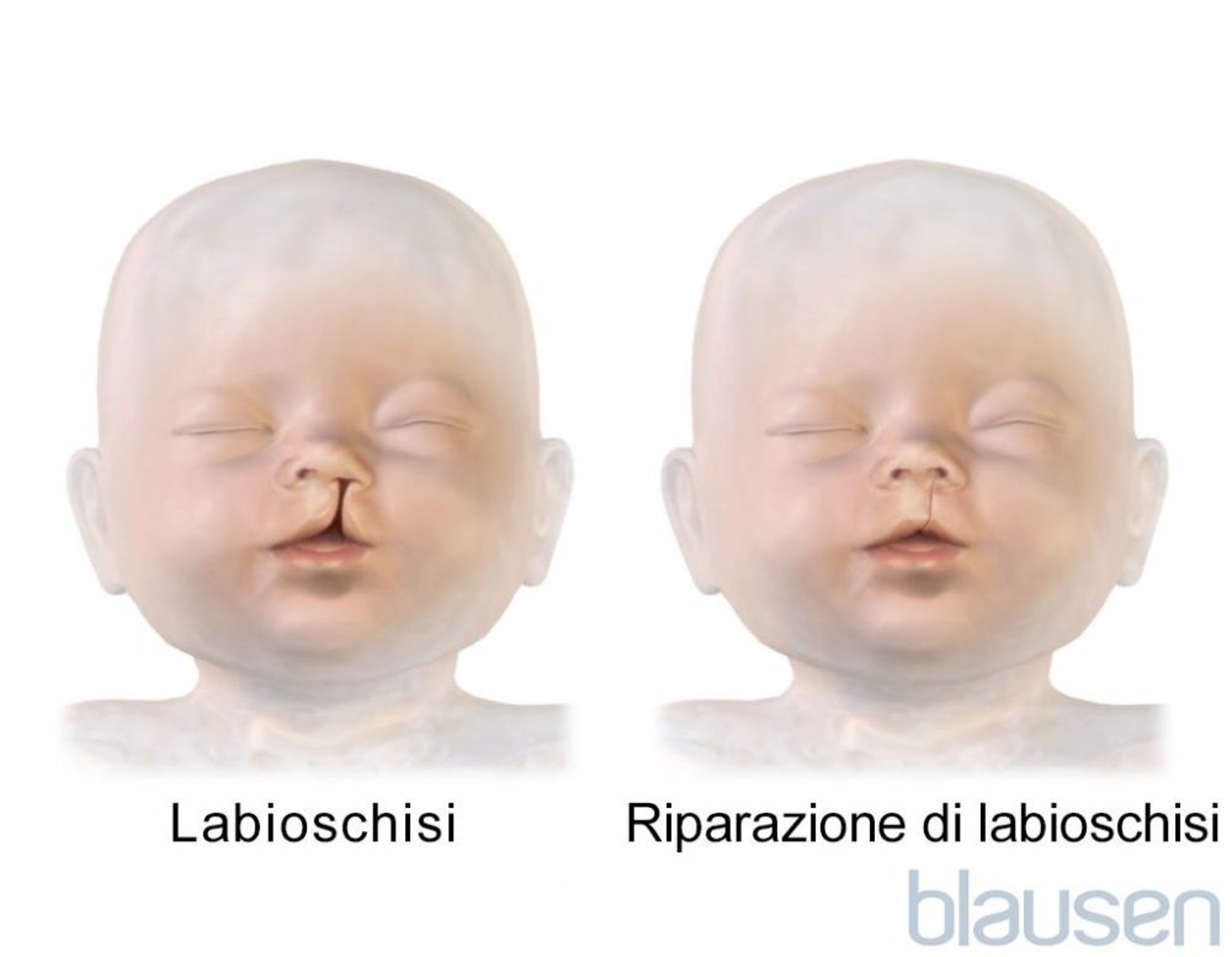 Riparazione di labioschisi