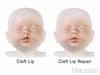 Cleft Lip Repair