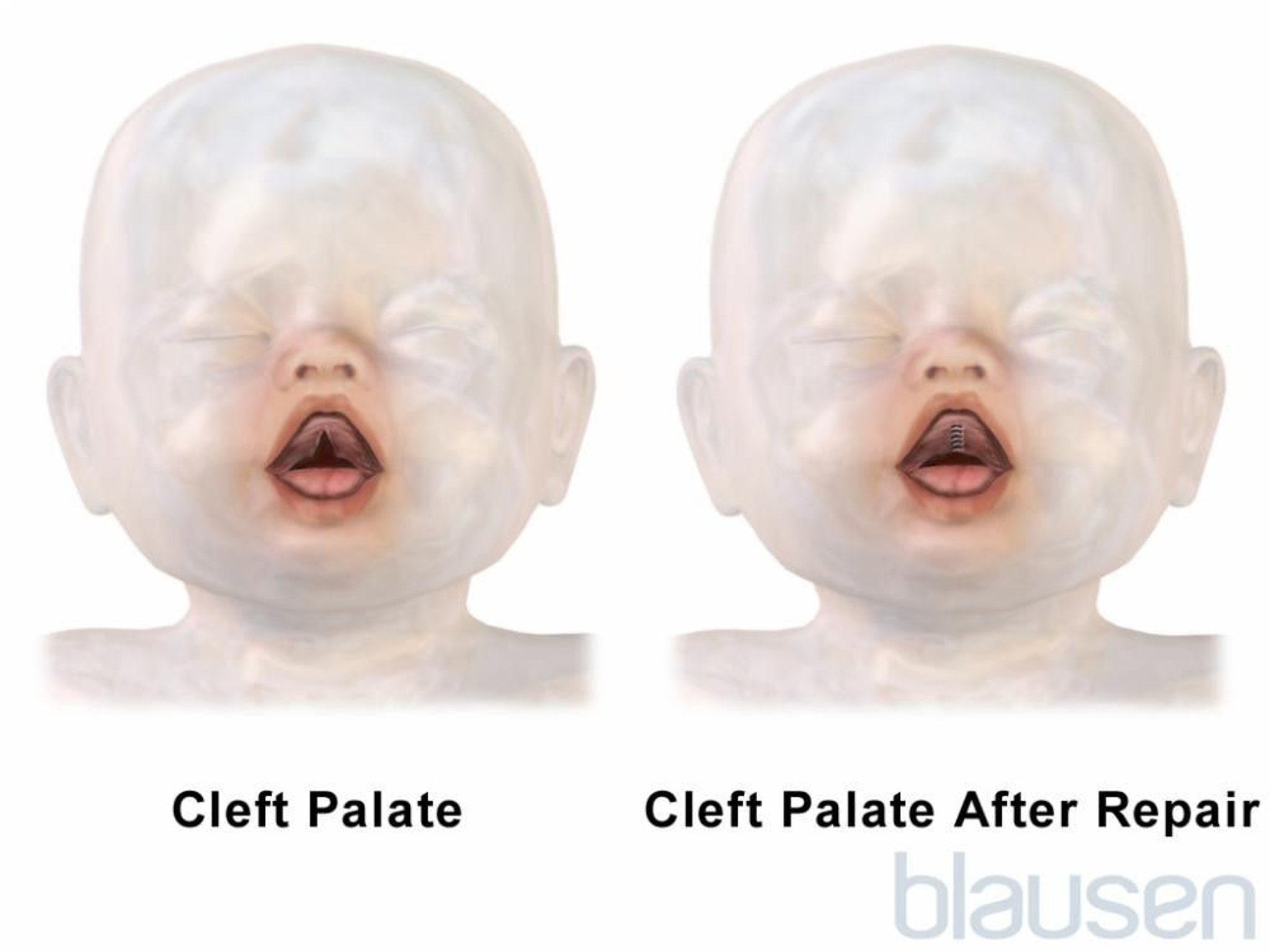 Cleft Palate Repair