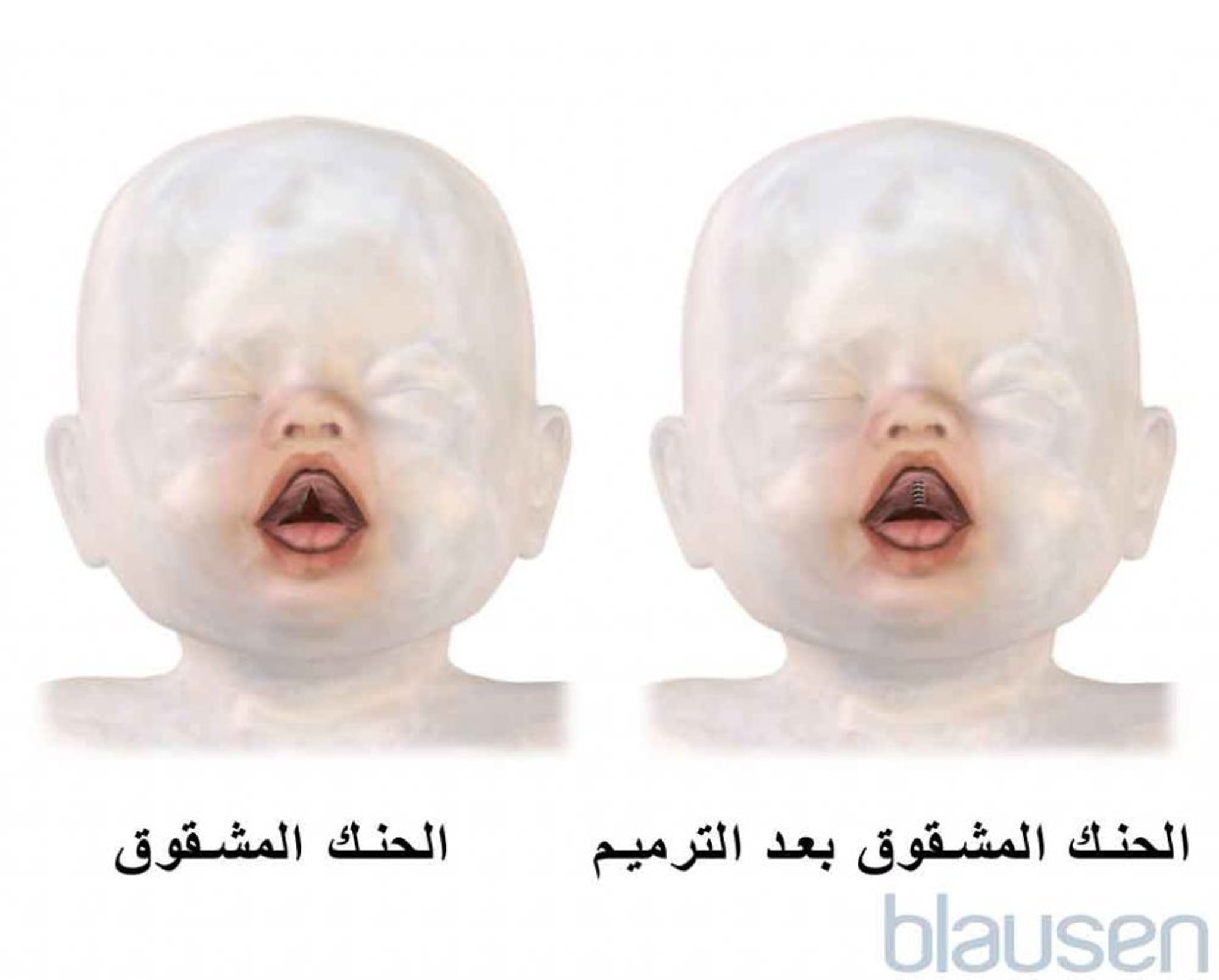 إصلاح الحنك المشقوق