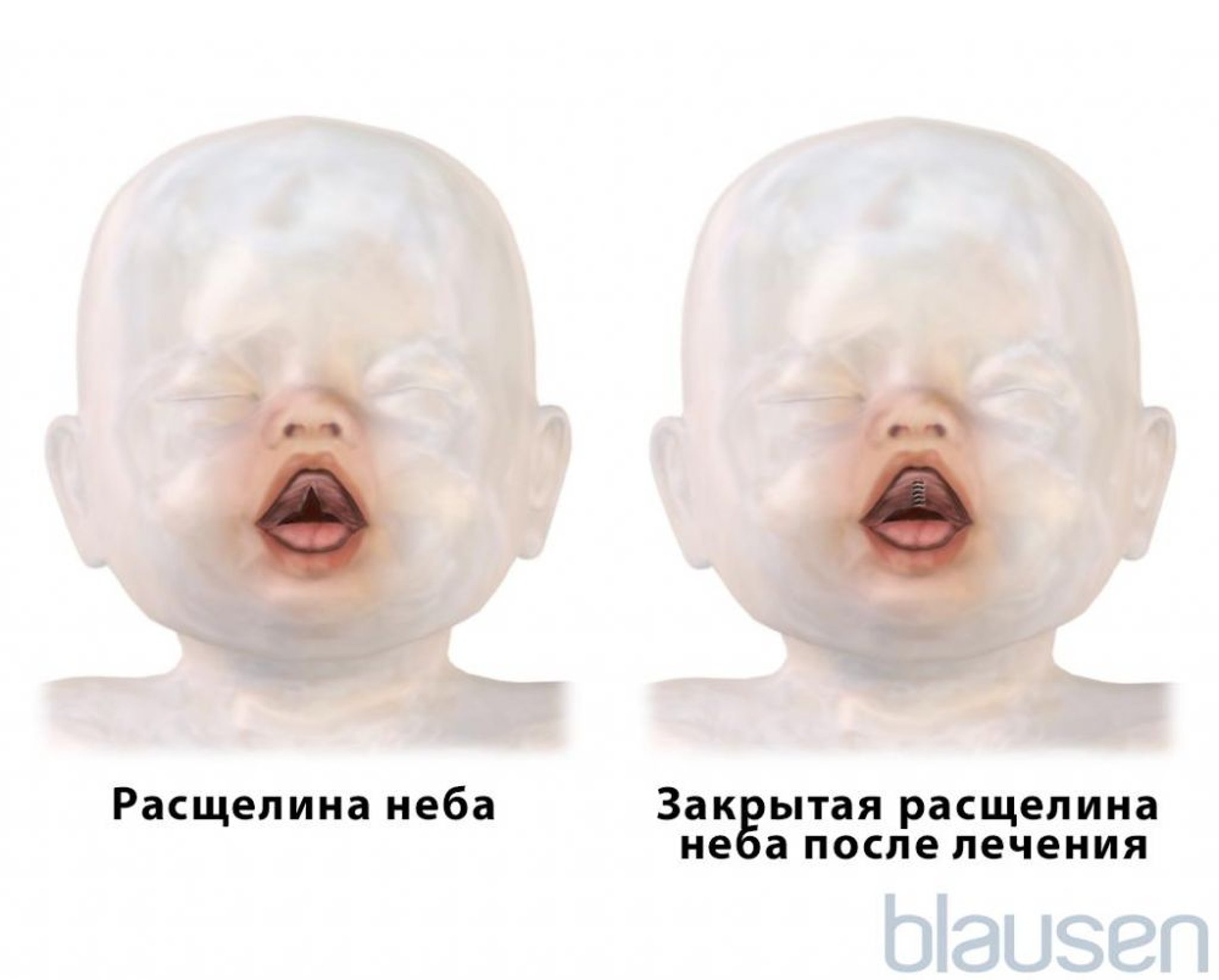 Закрытие расщелины неба