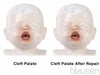 Cleft Palate Repair