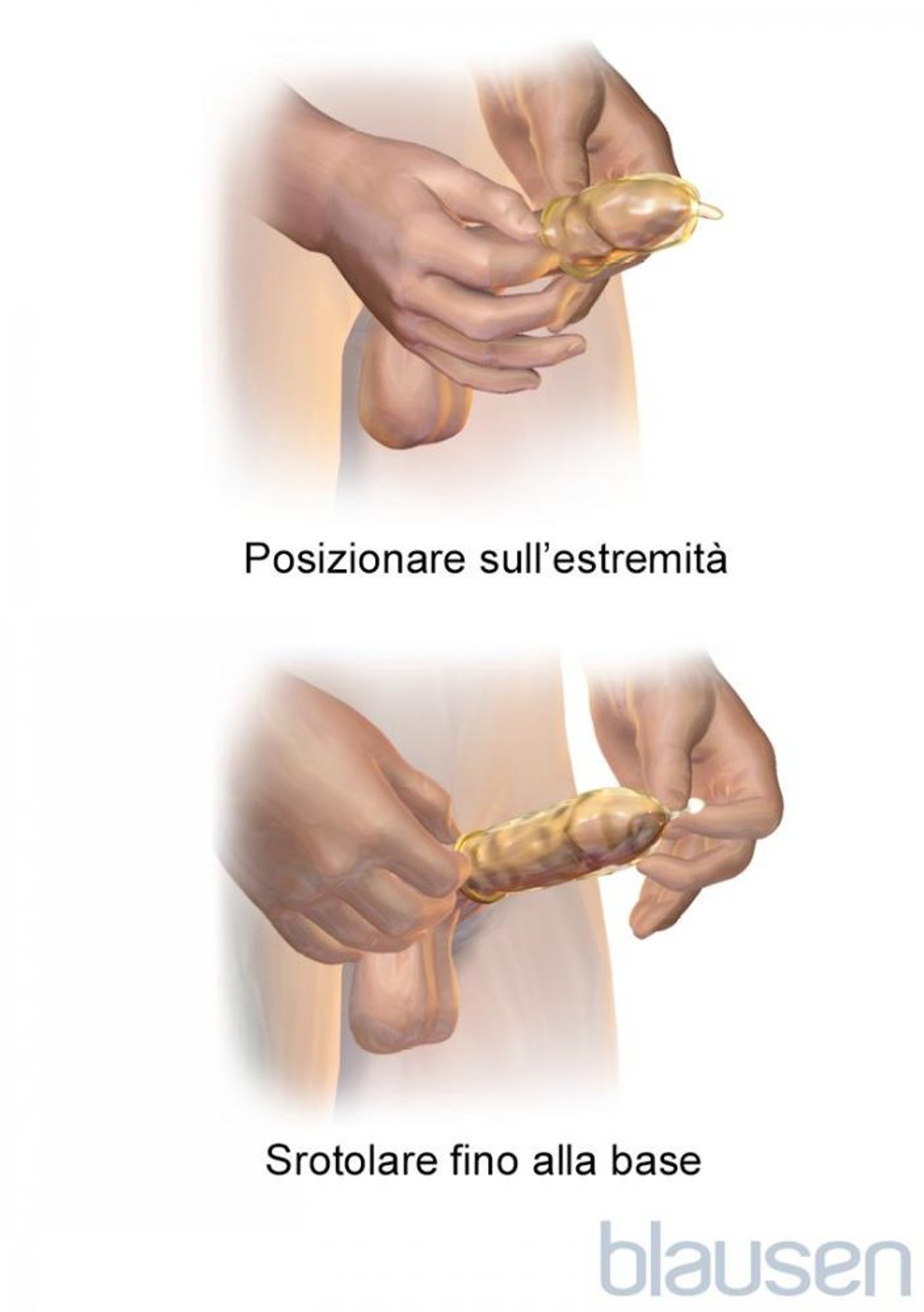 Come indossare un preservativo esterno