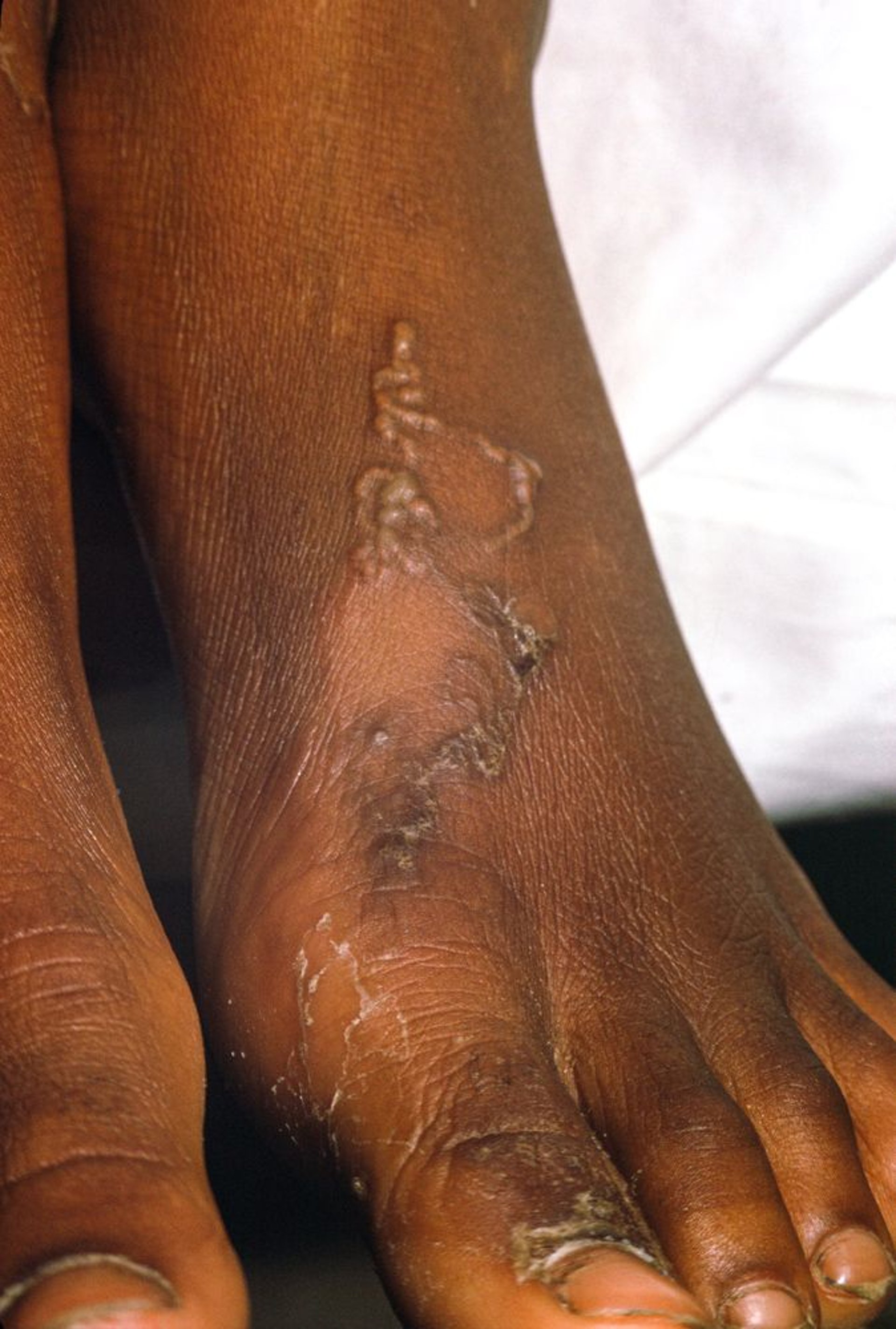 Cutaneous Larva Migrans